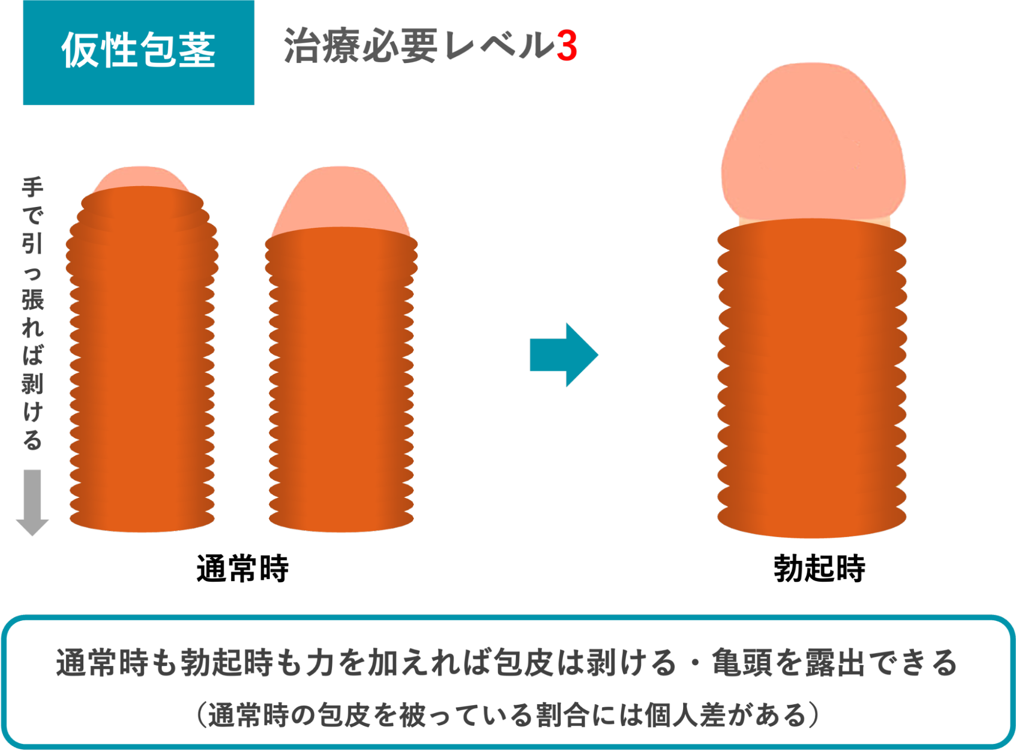 仮性包茎のイメージ
