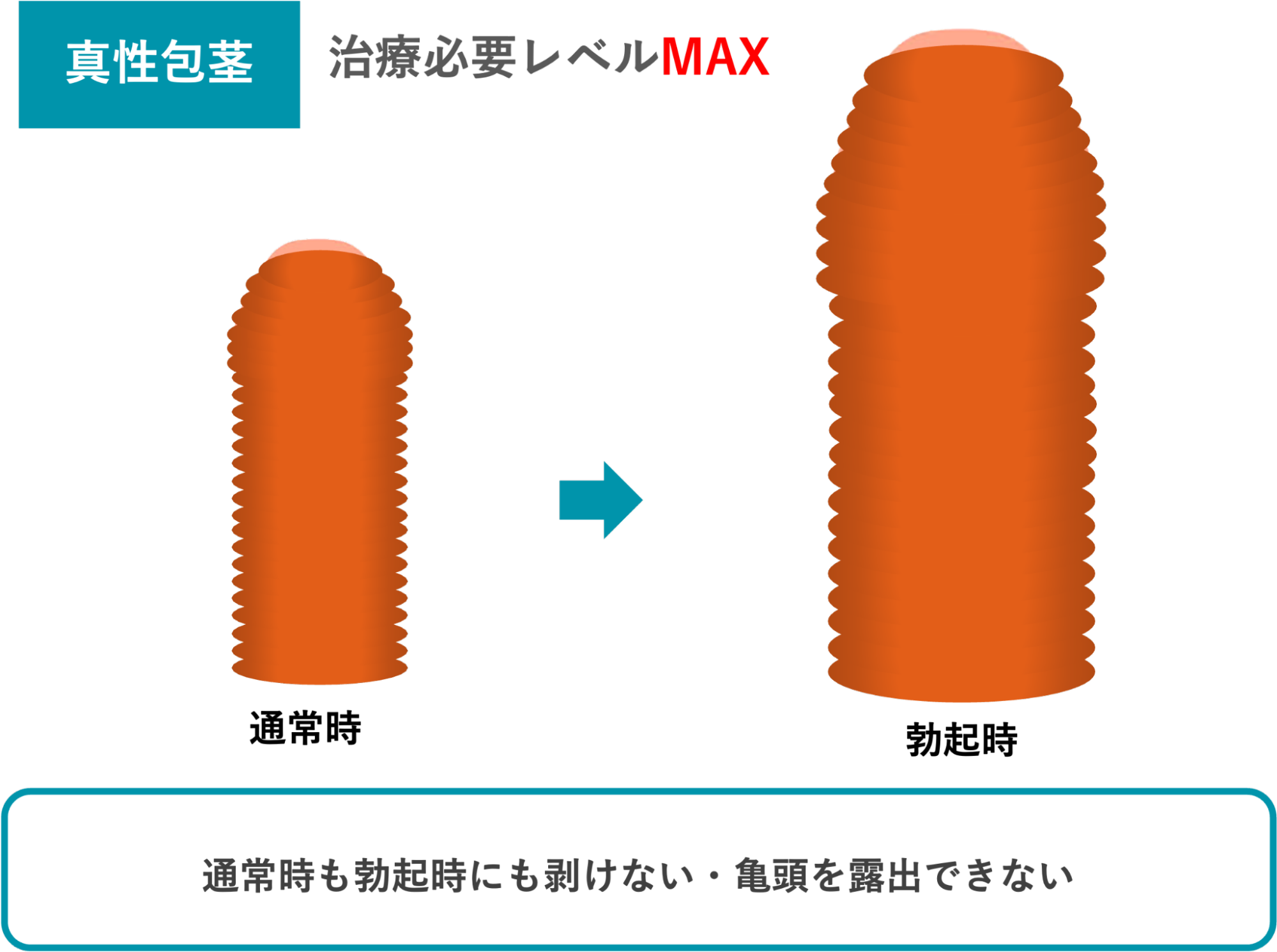 真性包茎のイメージ