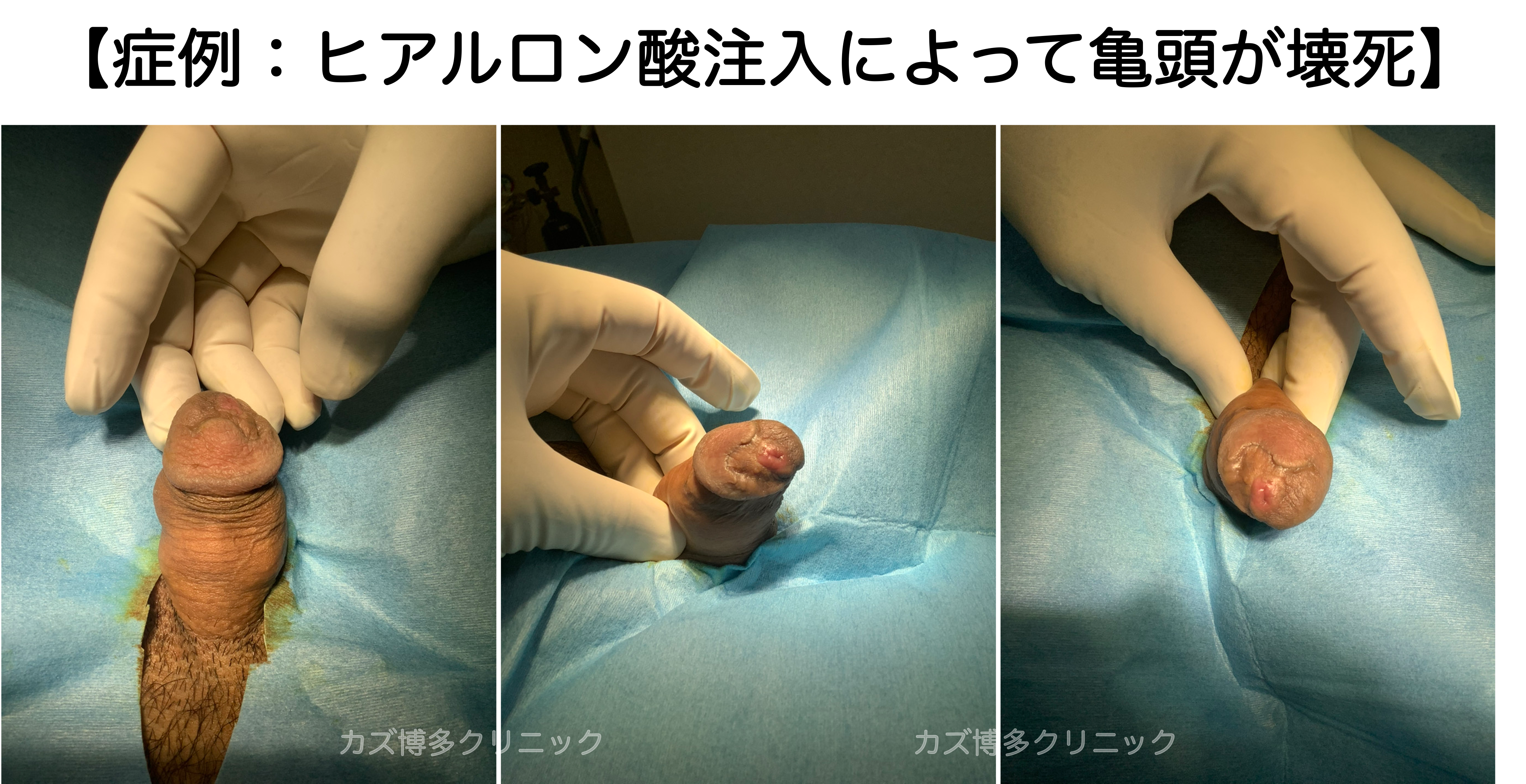 ヒアルロン酸注入で亀頭壊死の症例写真