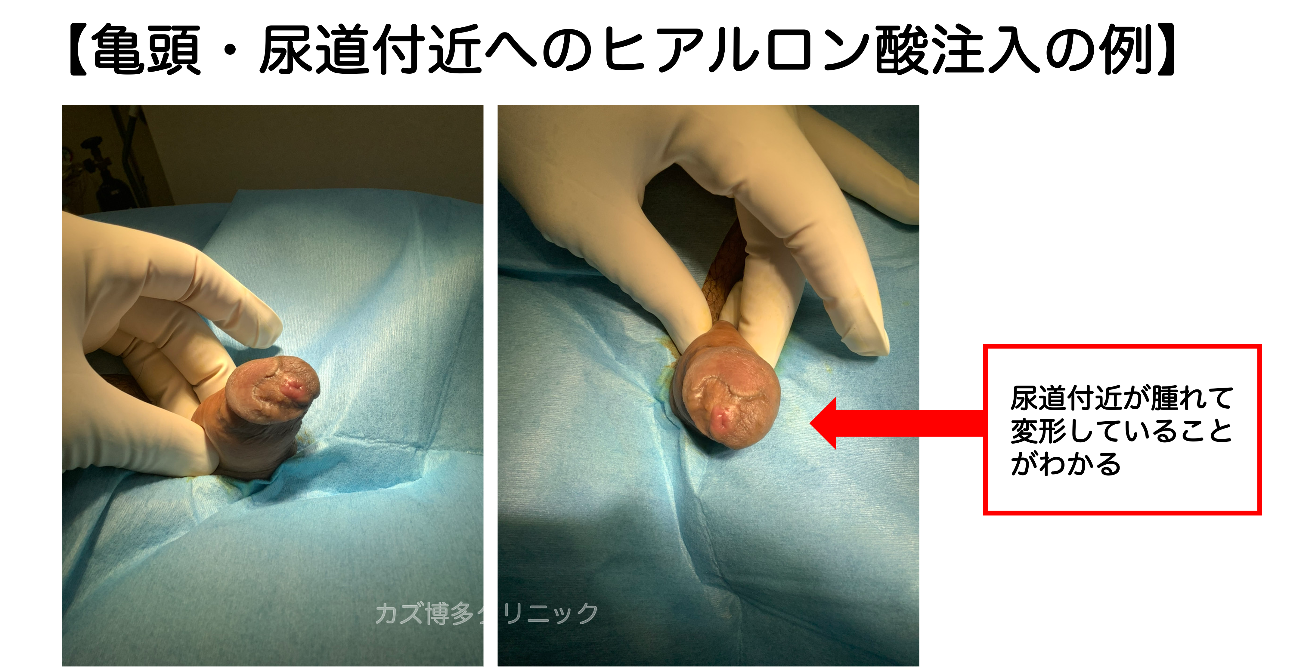 亀頭壊死の症例写真