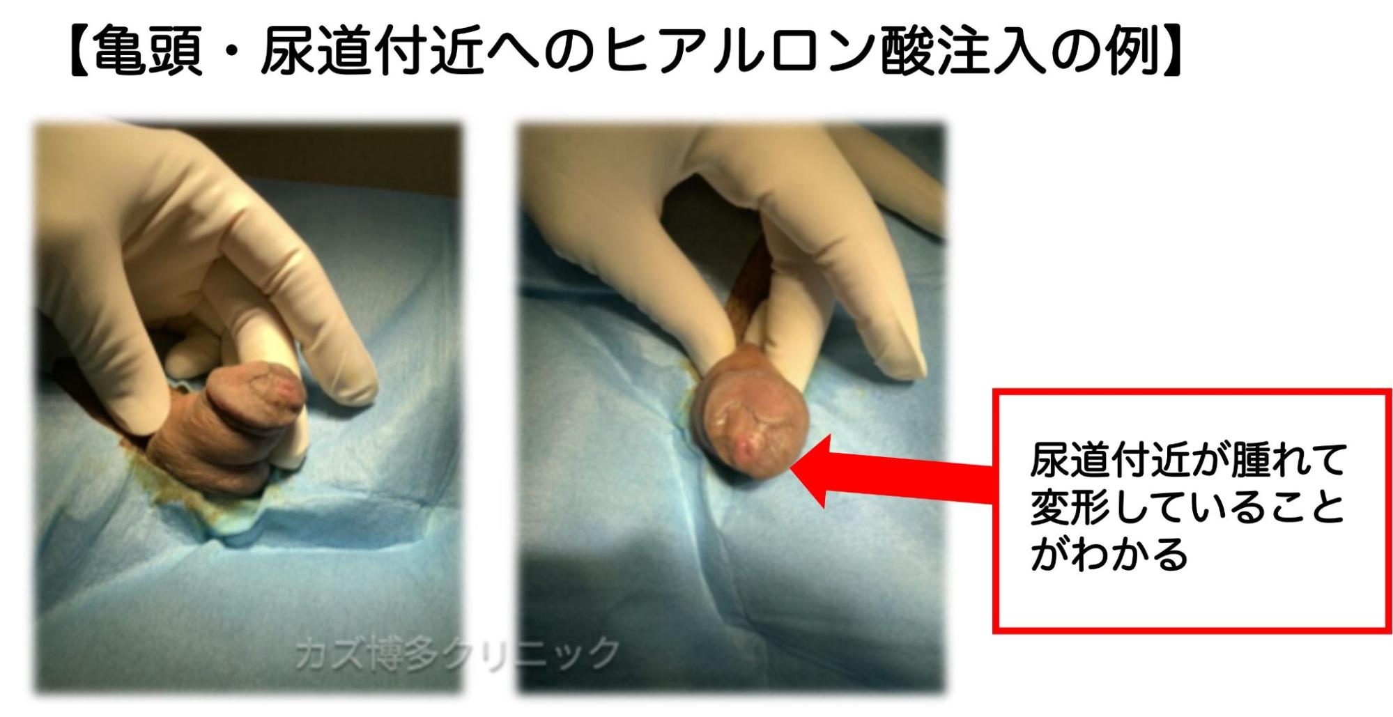 ヒアルロン酸注入で一部壊死と排尿障害になった症例