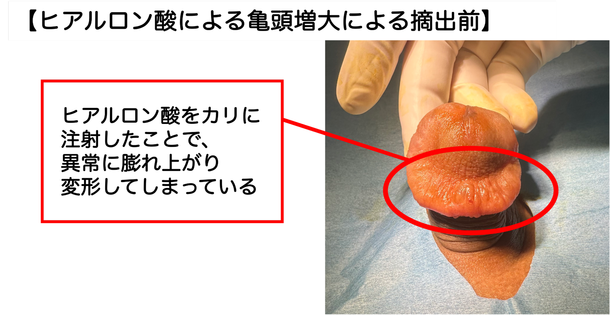 亀頭にヒアルロン酸を注入しカリ首が異常に腫れ上がった症例
