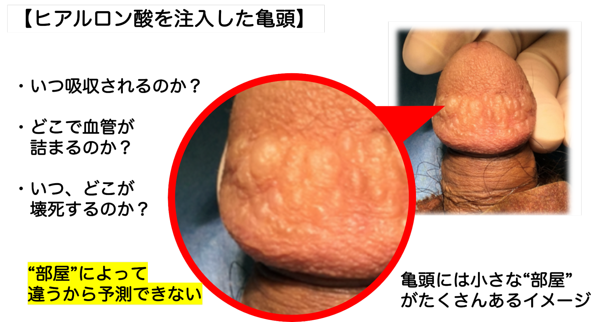 亀頭へのヒアルロン酸注入で表面がデコボコになった症例