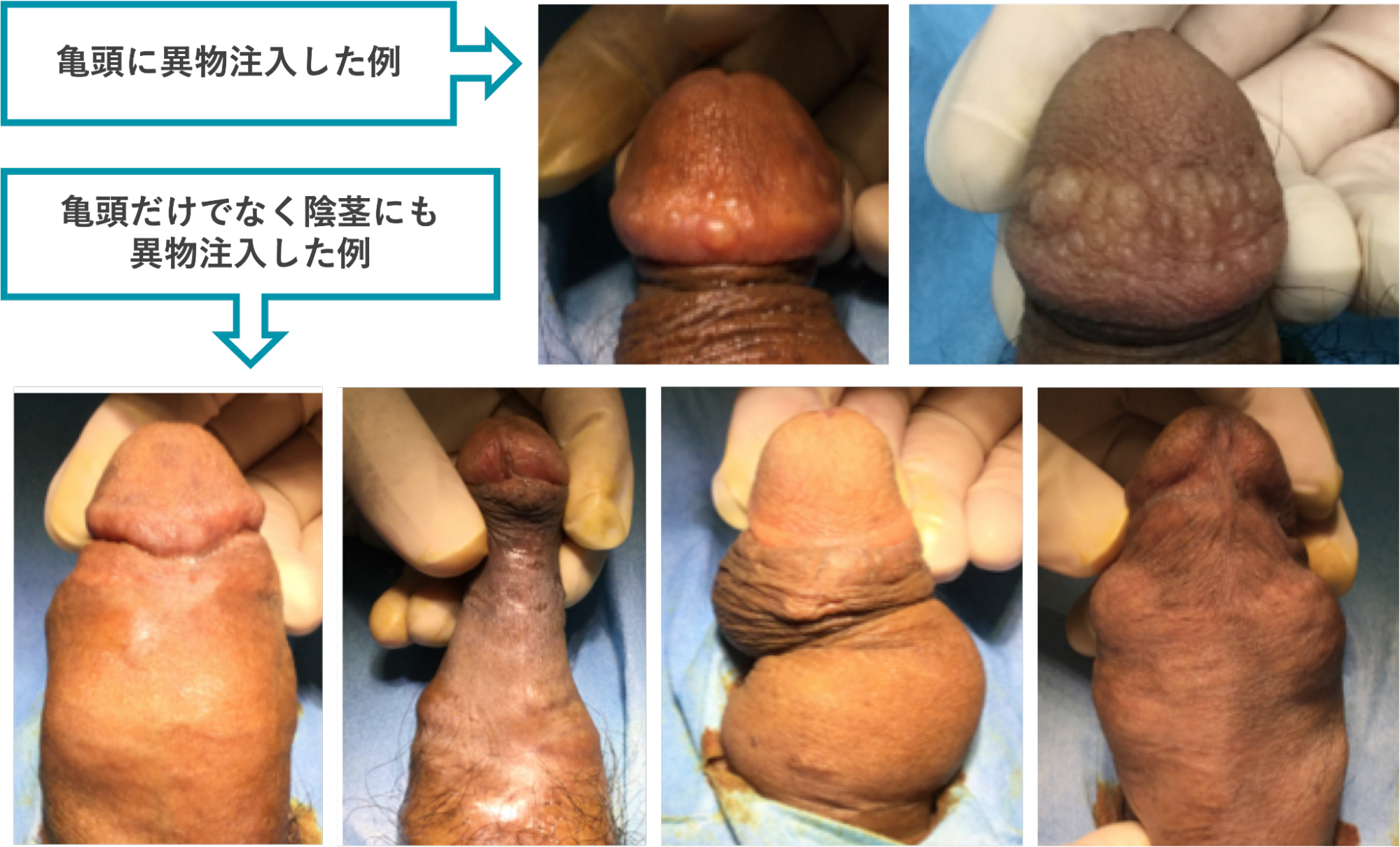 異物注入で異常な形に変形した症例