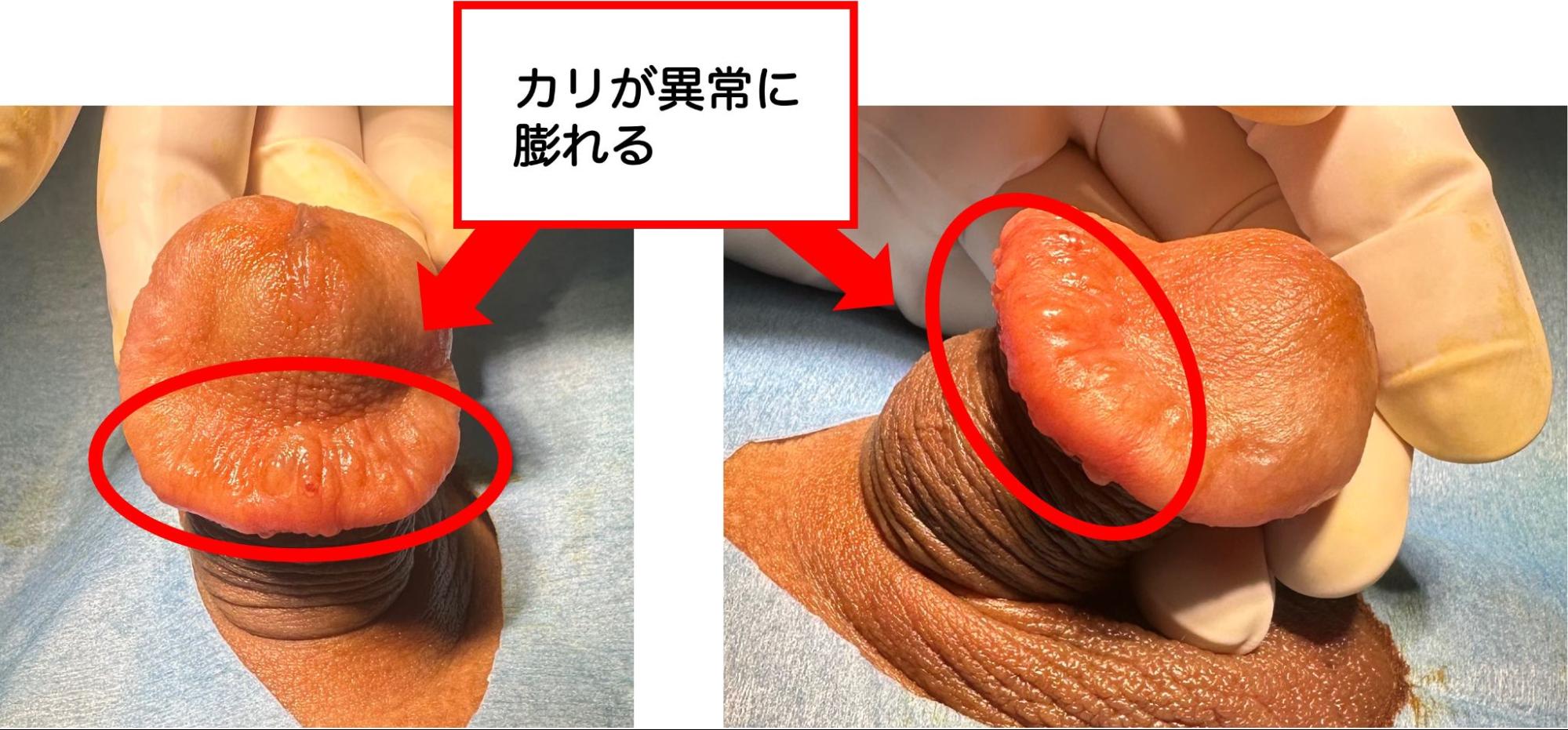 ヒアルロン酸注入でカリ首が異常に腫れ上がり変形した症例