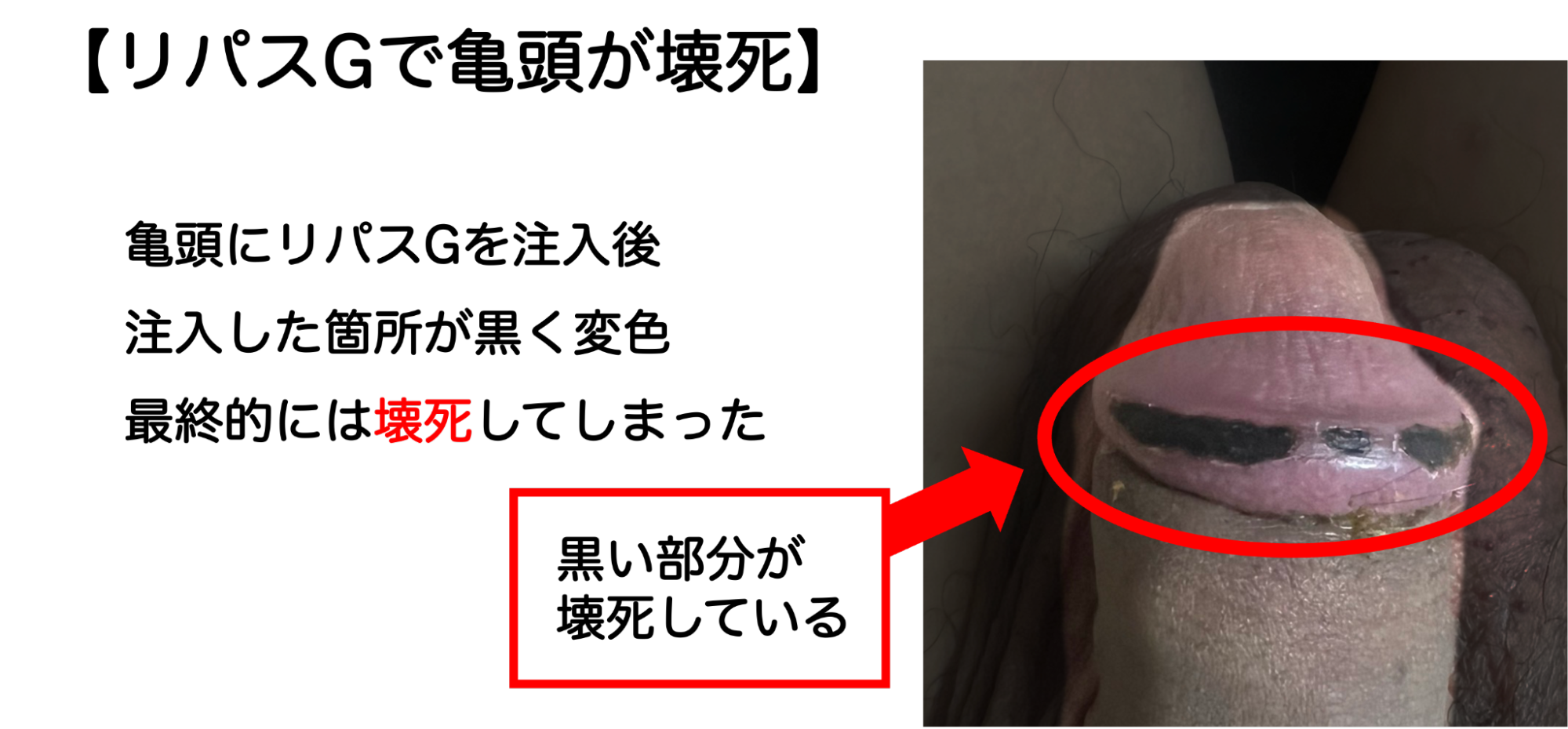リパスGを注入したことで亀頭が壊死した症例