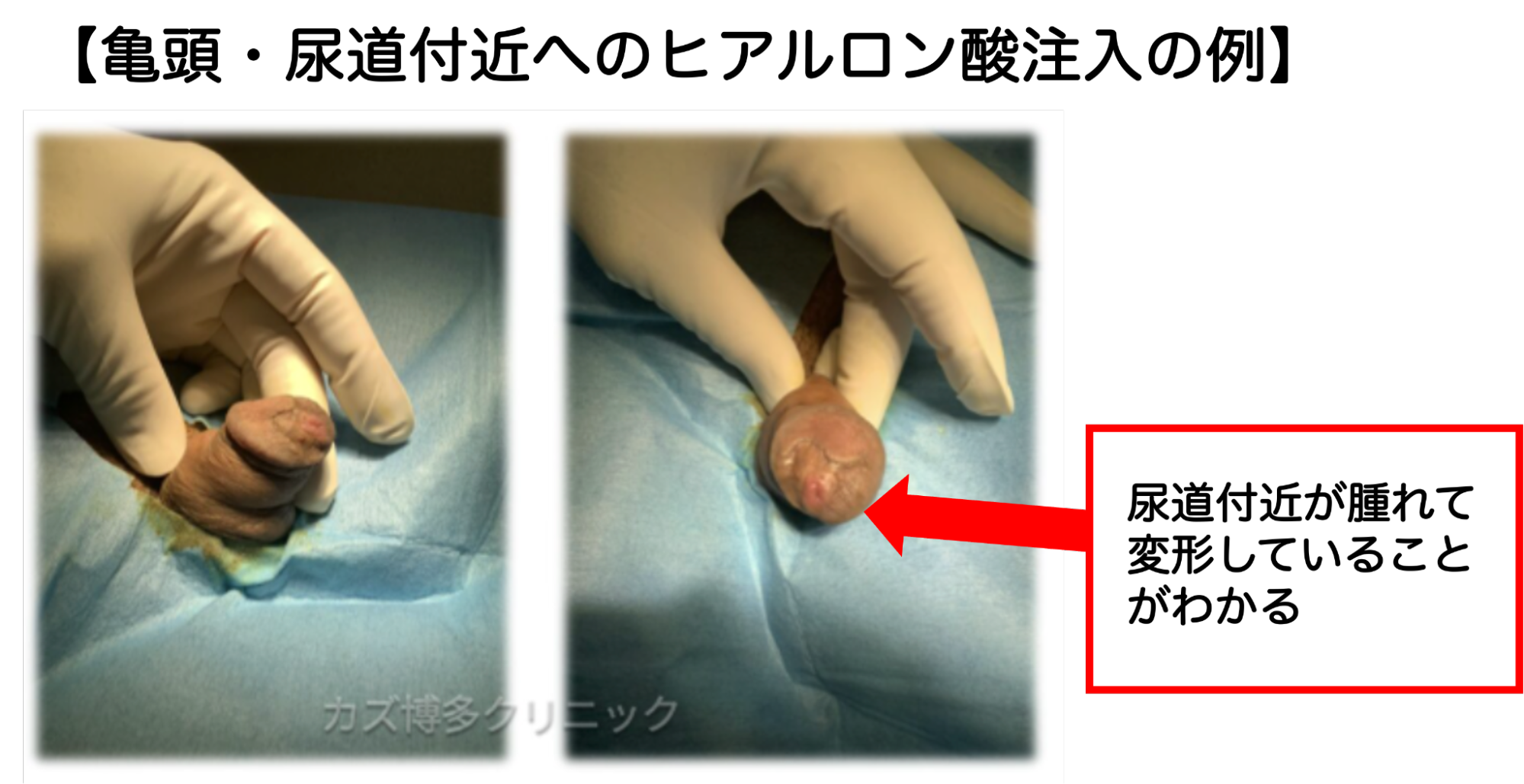 ヒアルロン酸注入で見た目も悪く尿道を圧迫された症例