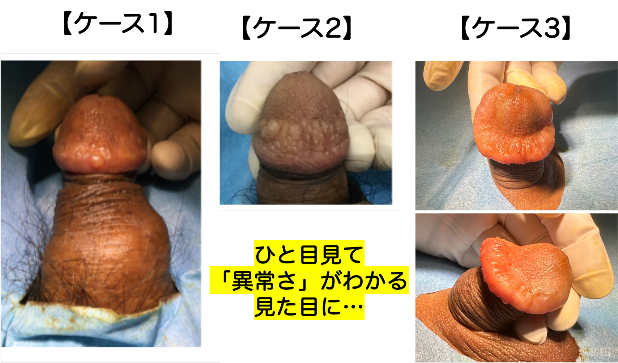 異物注入で見るも無残な姿になったケース