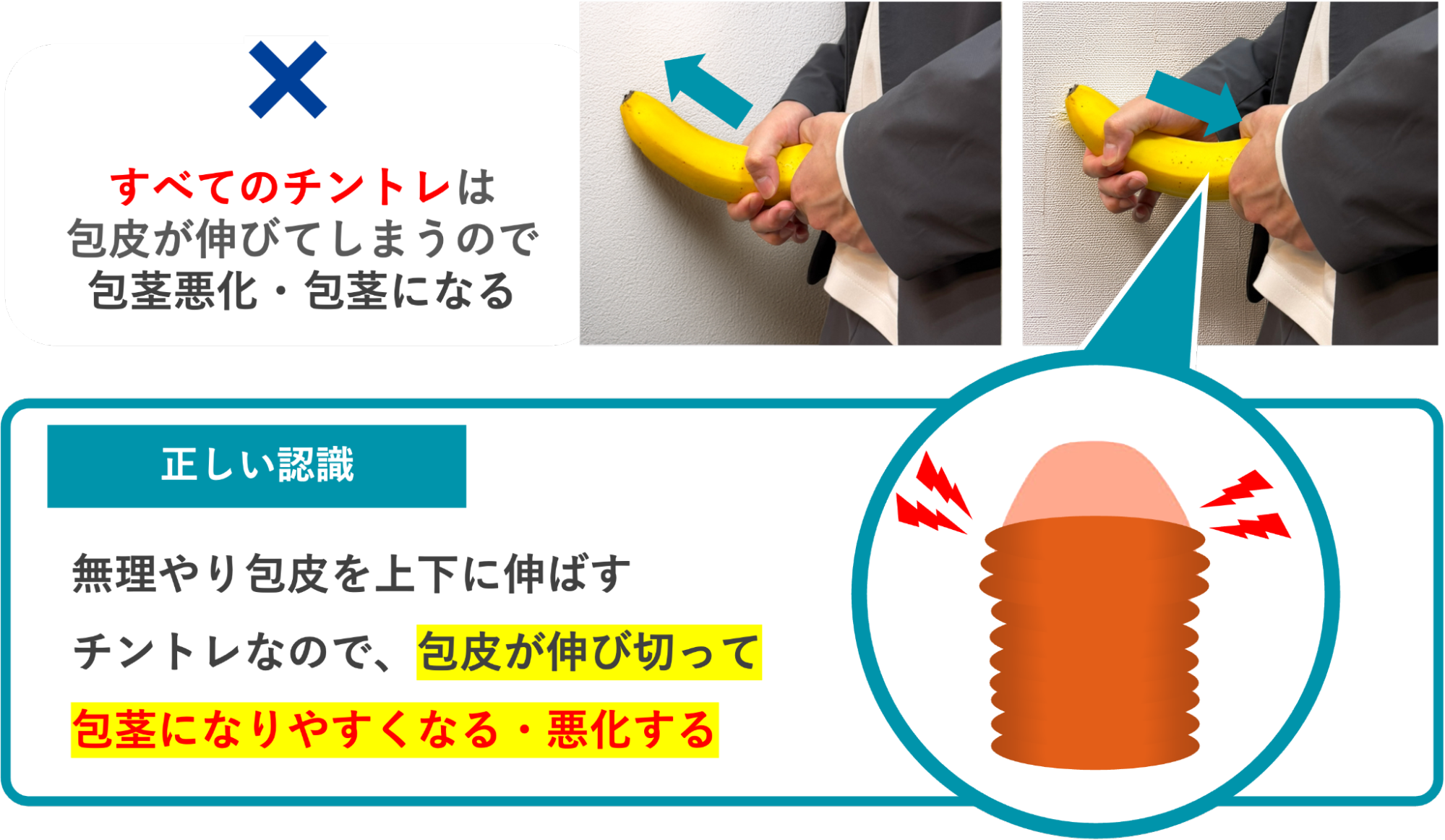チントレによって包茎が悪化する理由の解説