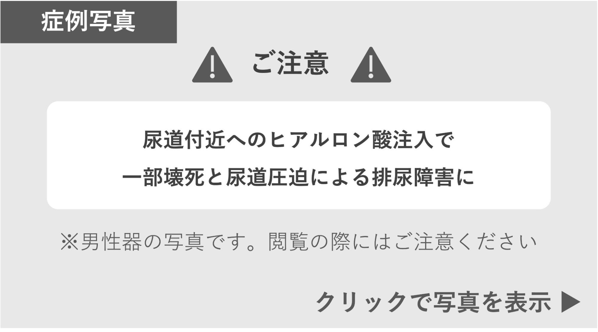 ヒアルロン酸注入で一部壊死と排尿障害になった症例 症例写真閲覧の警告