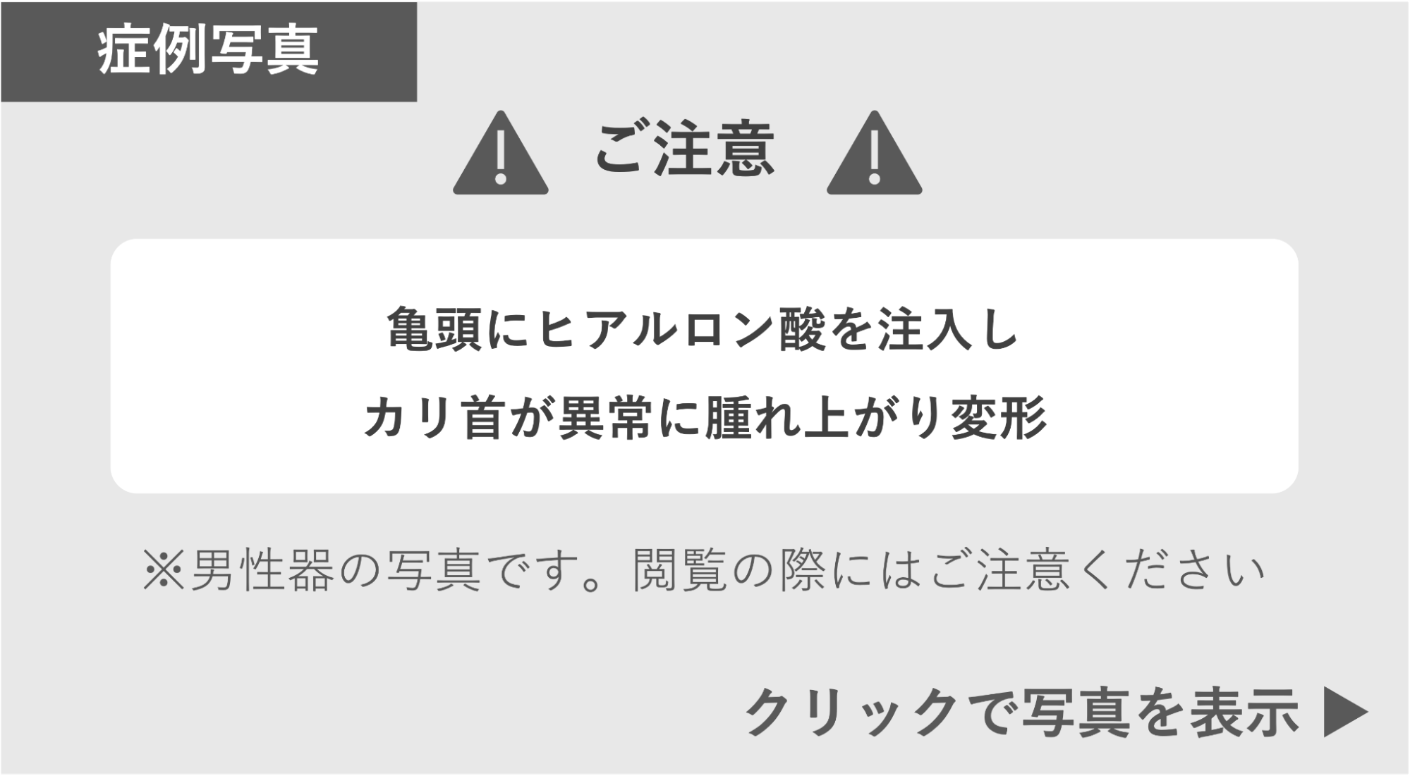 亀頭にヒアルロン酸を注入しカリ首が異常に腫れ上がった症例 症例写真閲覧の警告