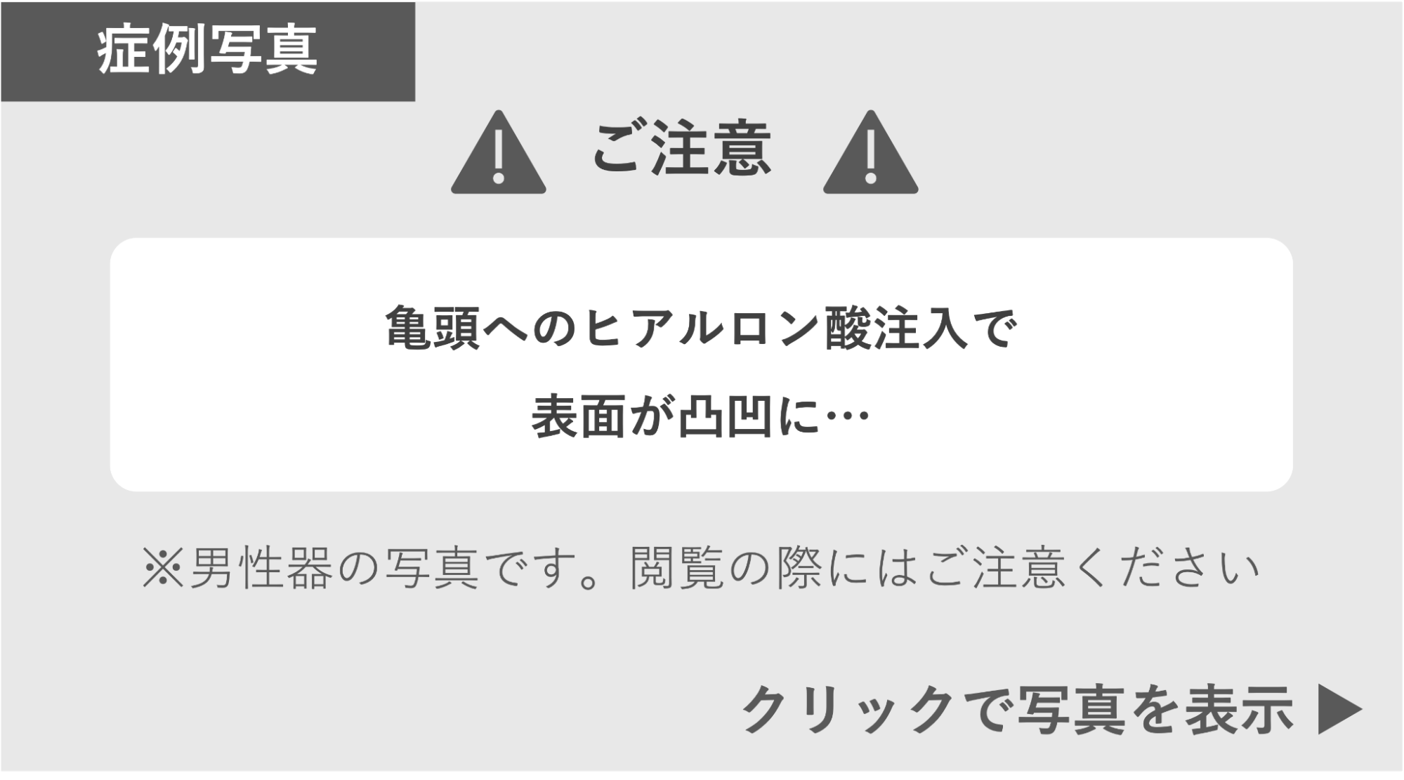 亀頭へのヒアルロン酸注入で表面がデコボコになった症例 症例写真閲覧の警告