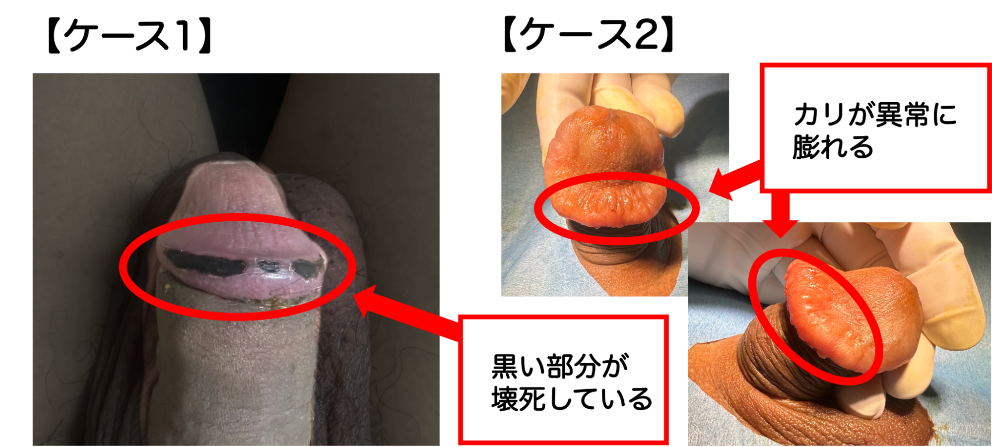 異物注入で大ダメージを受けたペニスの症例写真