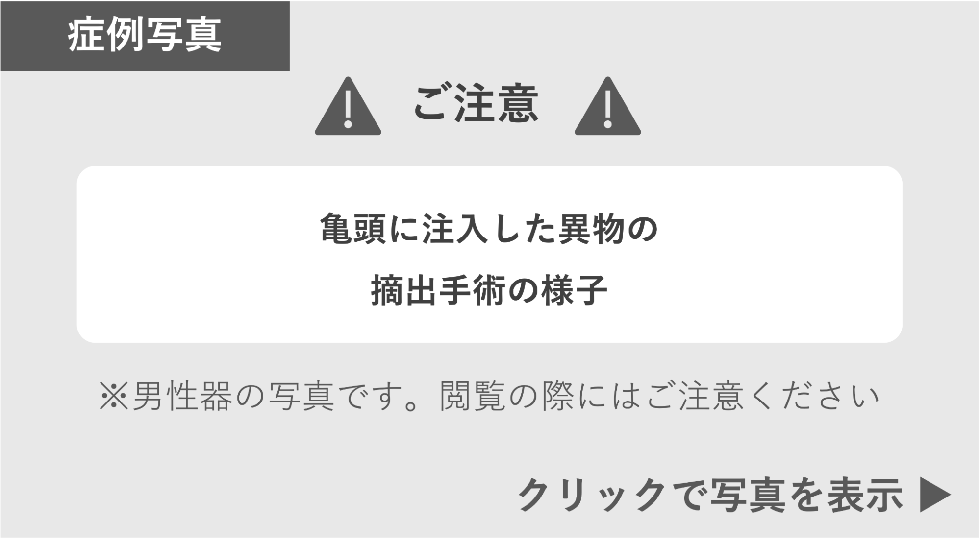 亀頭に注入した異物の摘出手術の様子 症例写真閲覧の警告