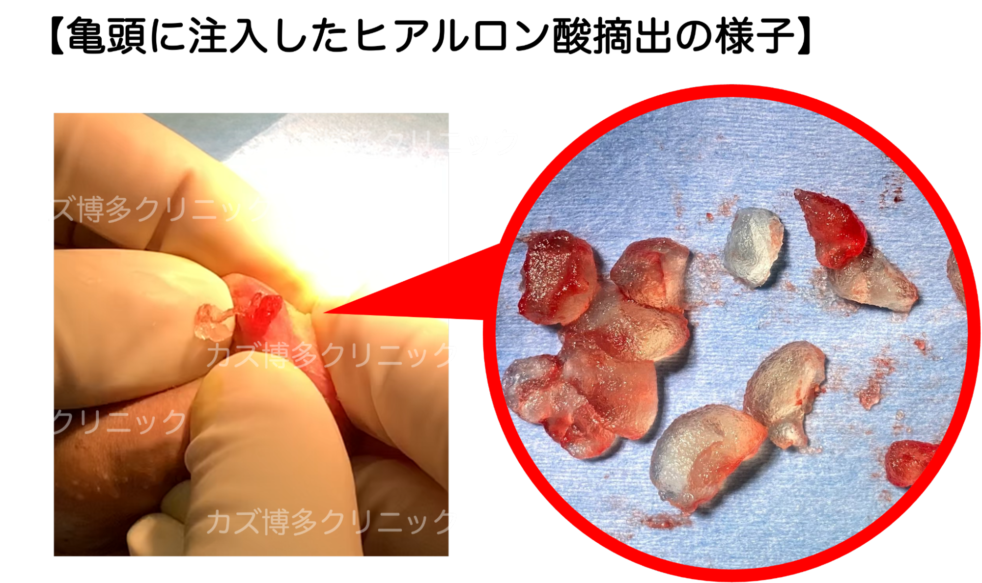 亀頭に注入した異物の摘出手術の様子