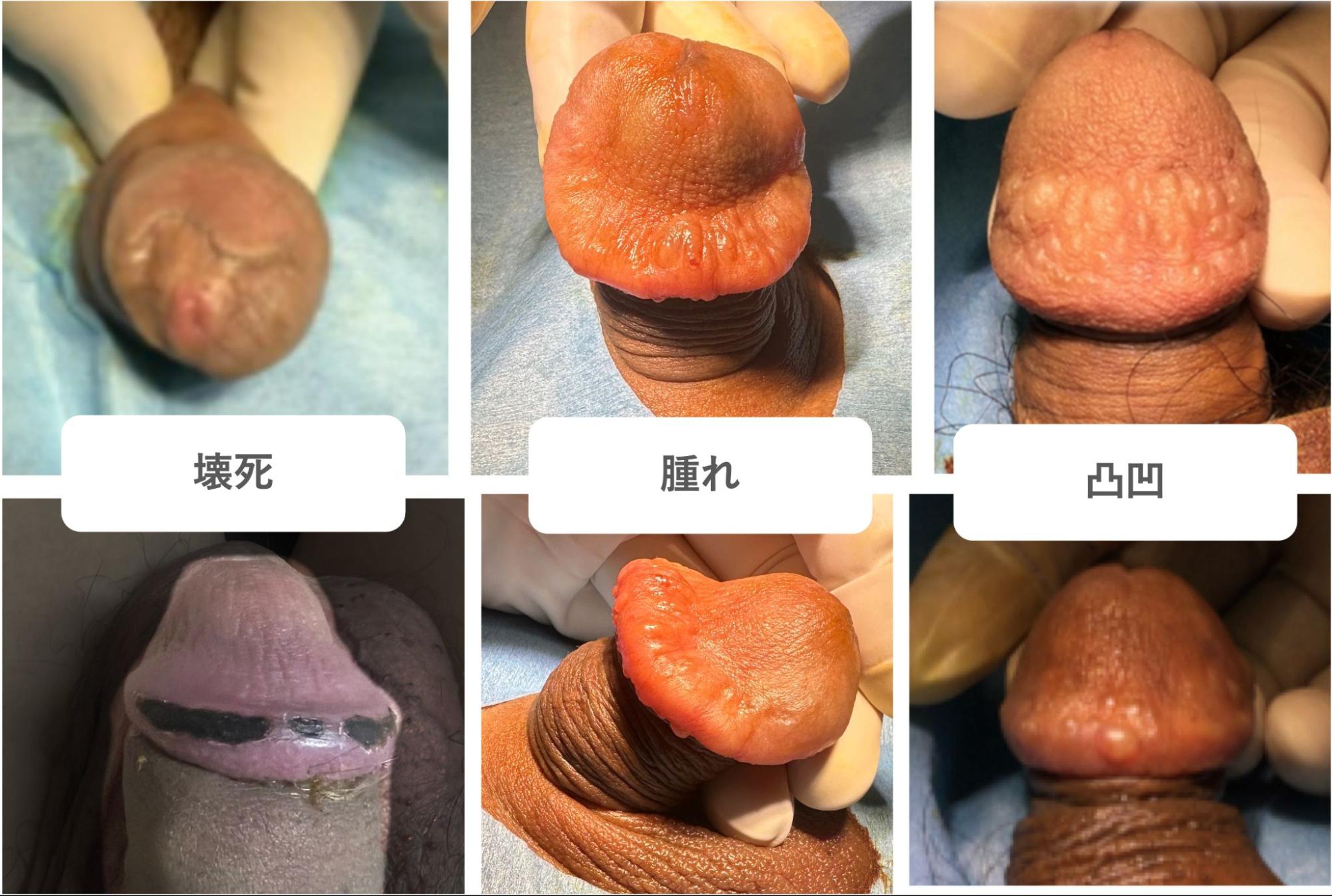 亀頭にヒアルロン酸など注入して失敗した3つの症例