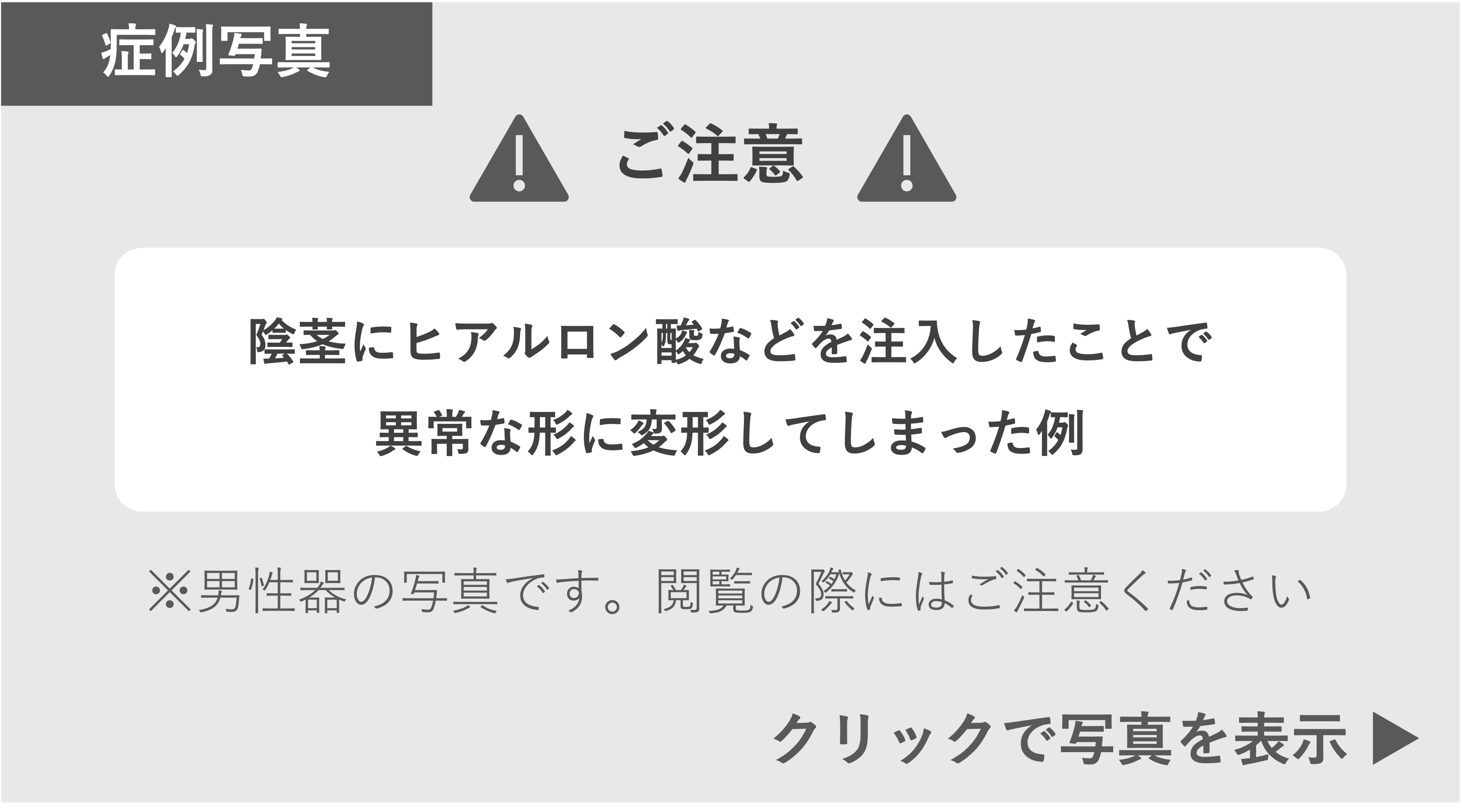 ヒアルロン酸を注入したことでアンバランスに膨れた症例 症例写真閲覧の警告