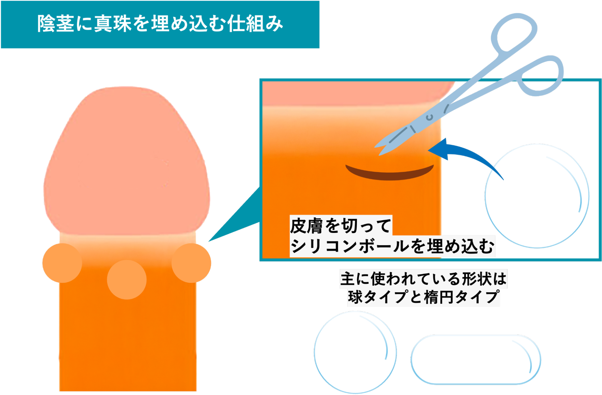 陰茎に真珠を埋め込む方法を解説したイメージ
