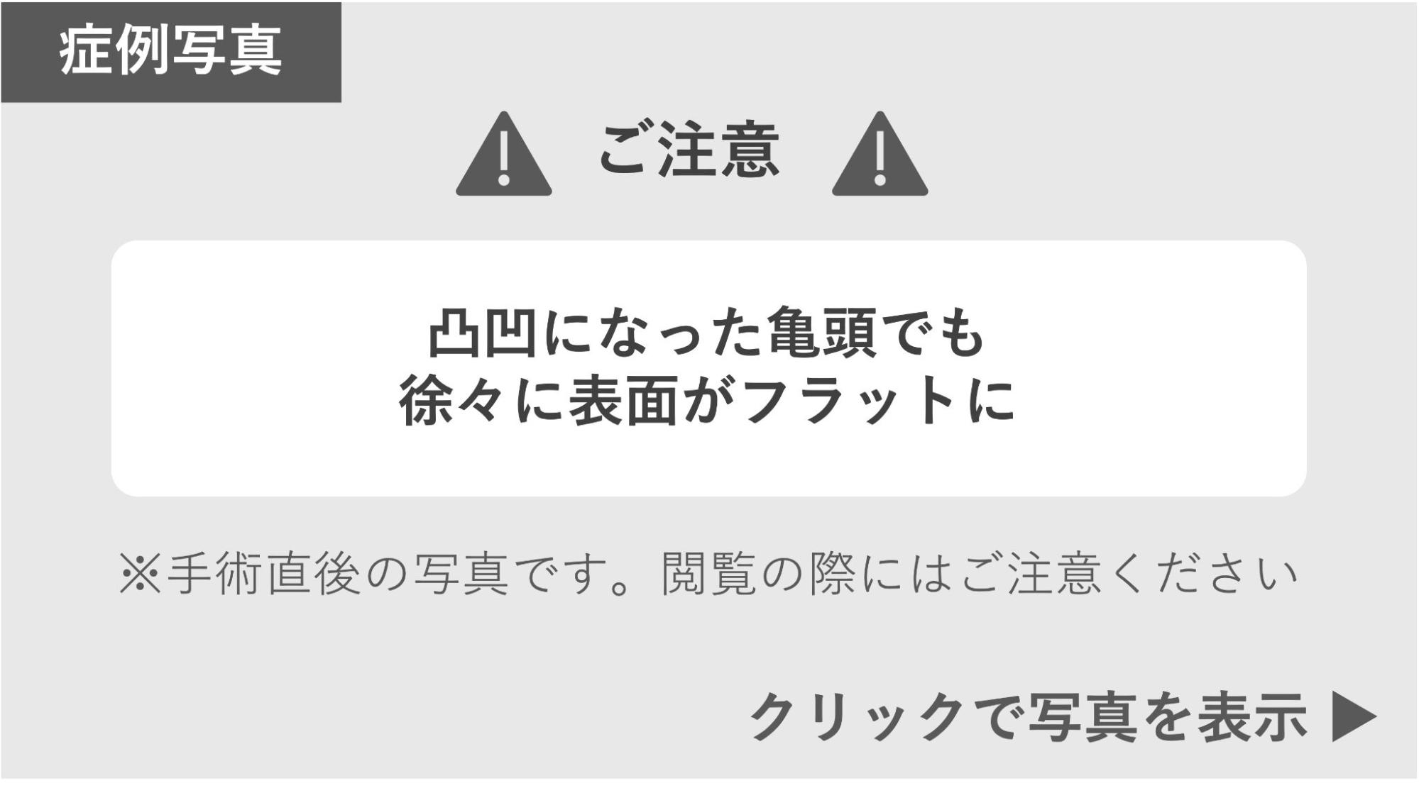 デコボコの亀頭の表面がフラットになった症例 症例写真閲覧の警告
