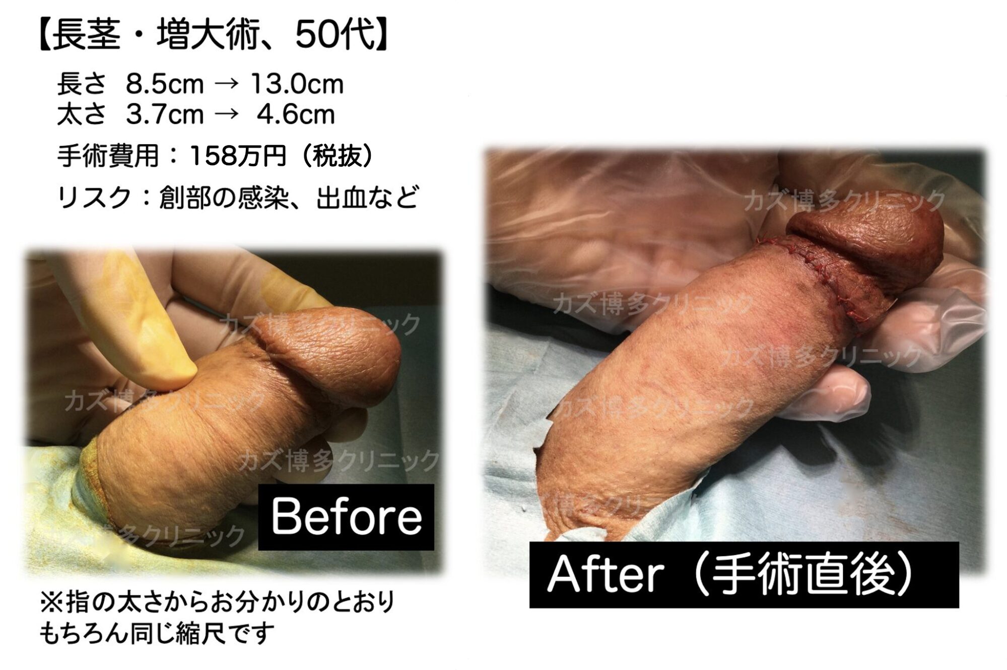 グランセンサー解除法によってサイズアップした症例