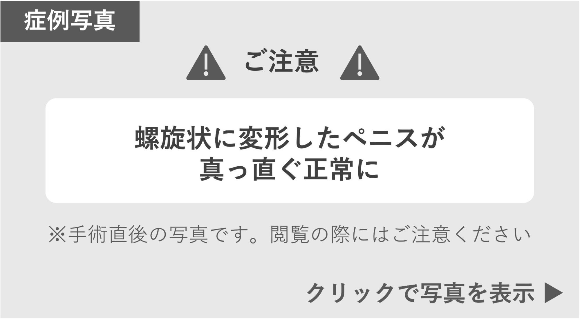 螺旋状に変形したペニスがまっすぐ正常になった症例 症例写真閲覧の警告