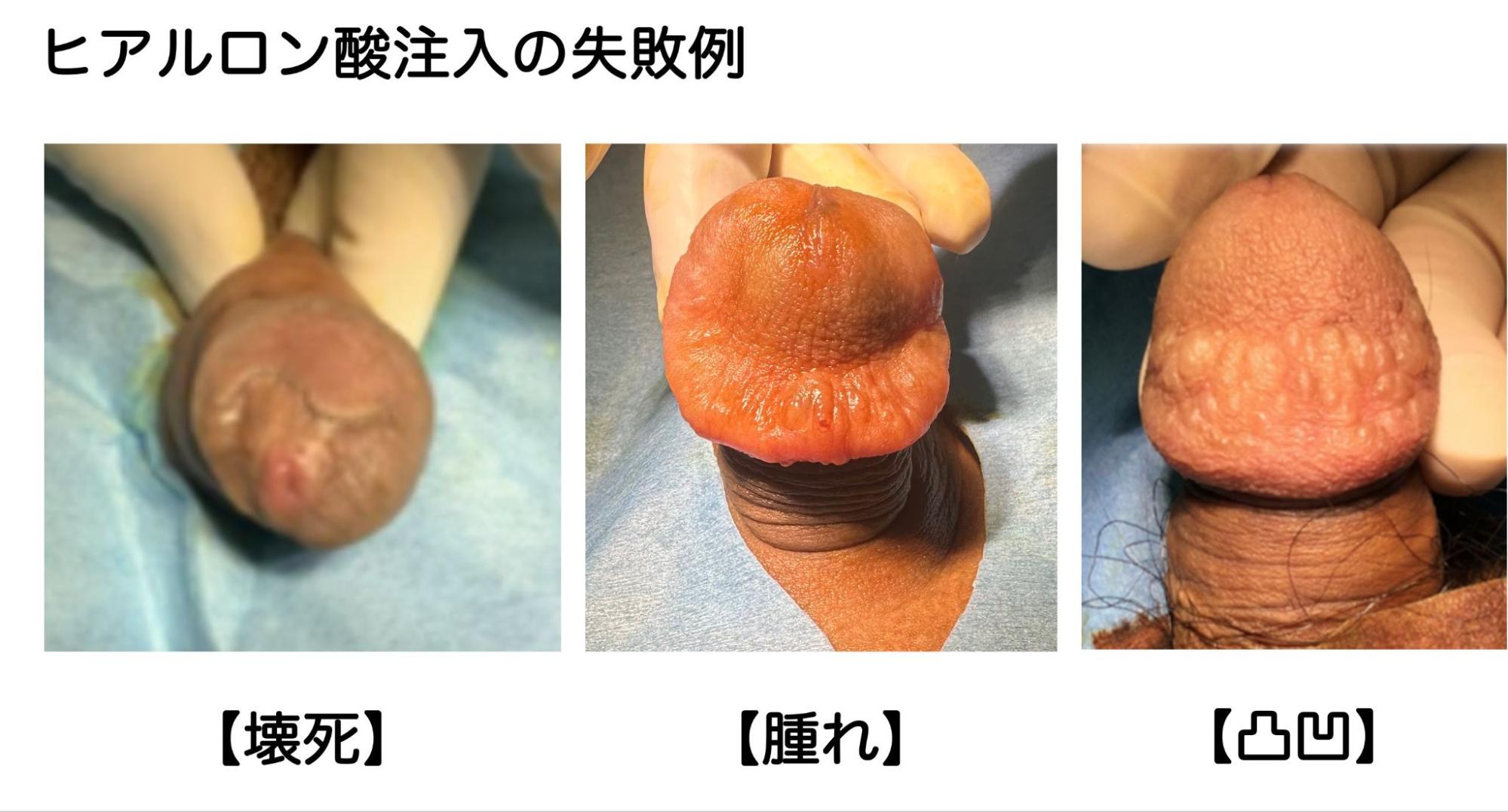 変色・腫れ・おうとつなどのヒアルロン酸失敗症例