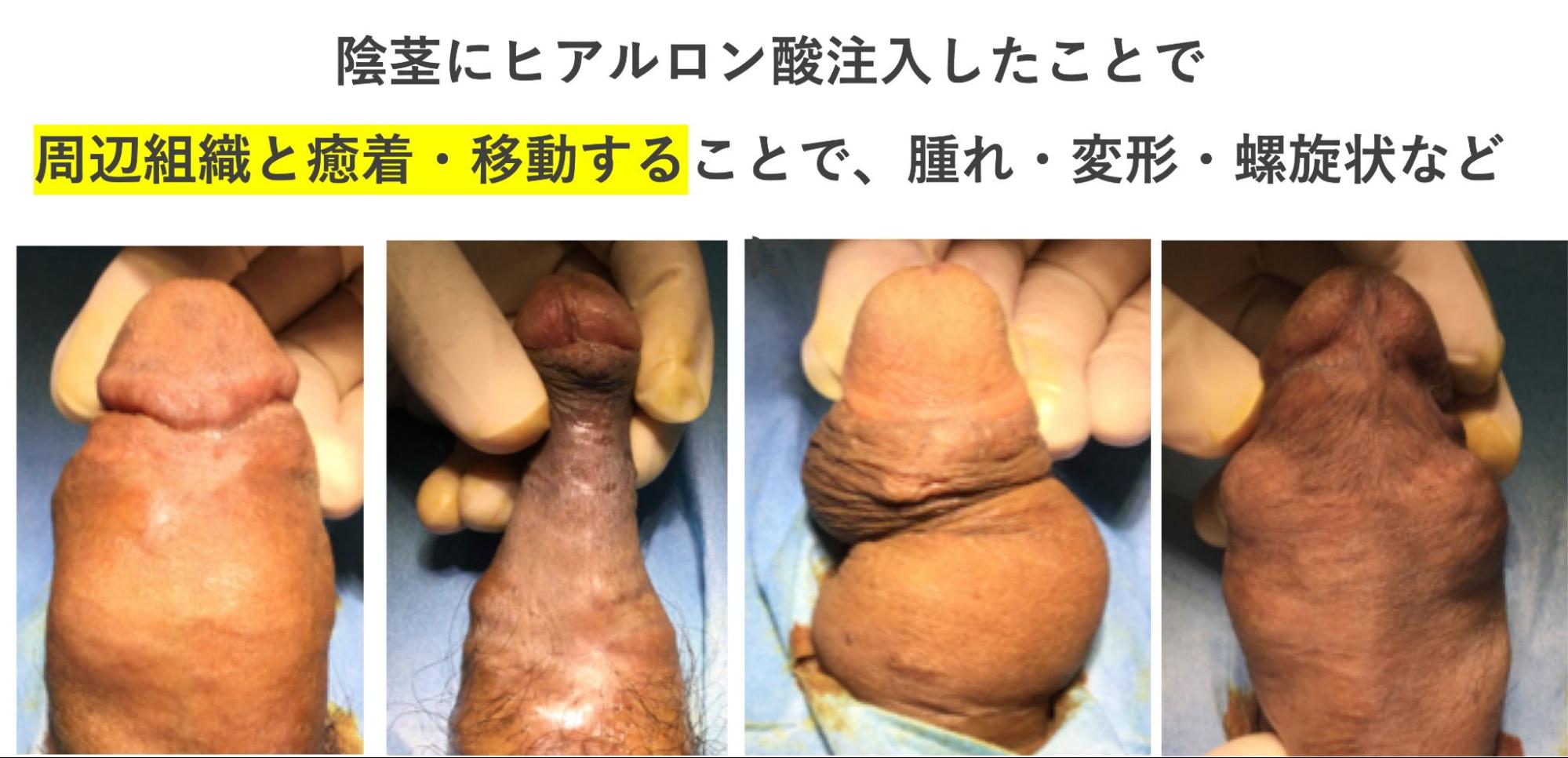 陰茎にヒアルロン酸など注入して失敗した4つの症例