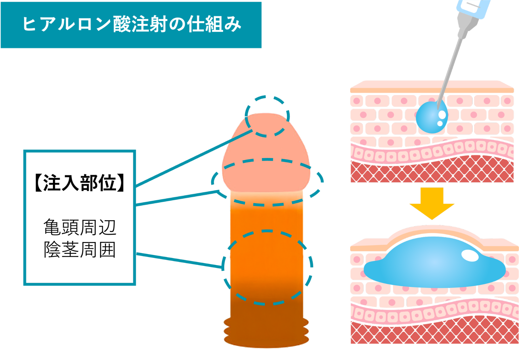 ペニスへのヒアルロン酸注射の仕組み