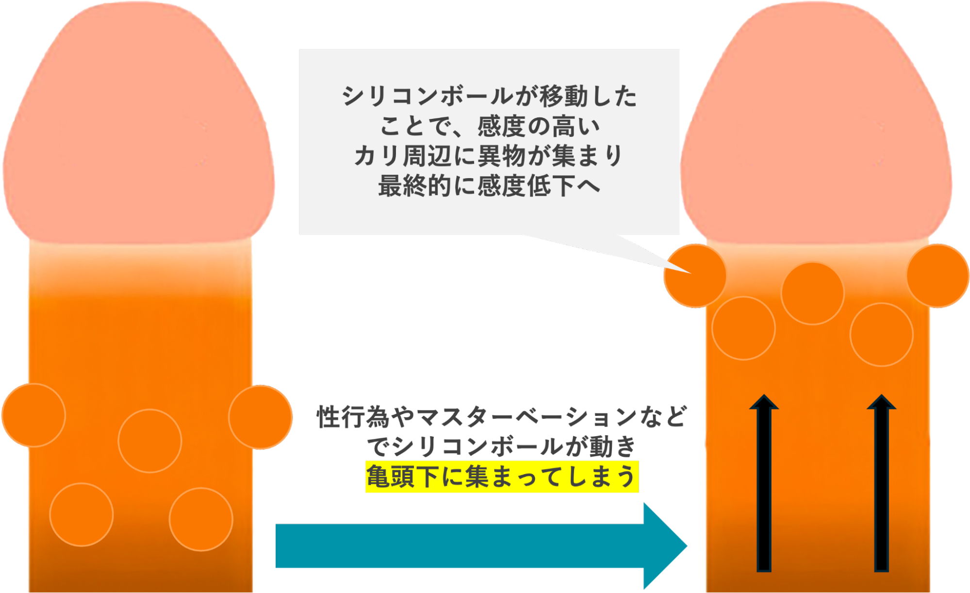 真珠が亀頭直下に移動するイメージ