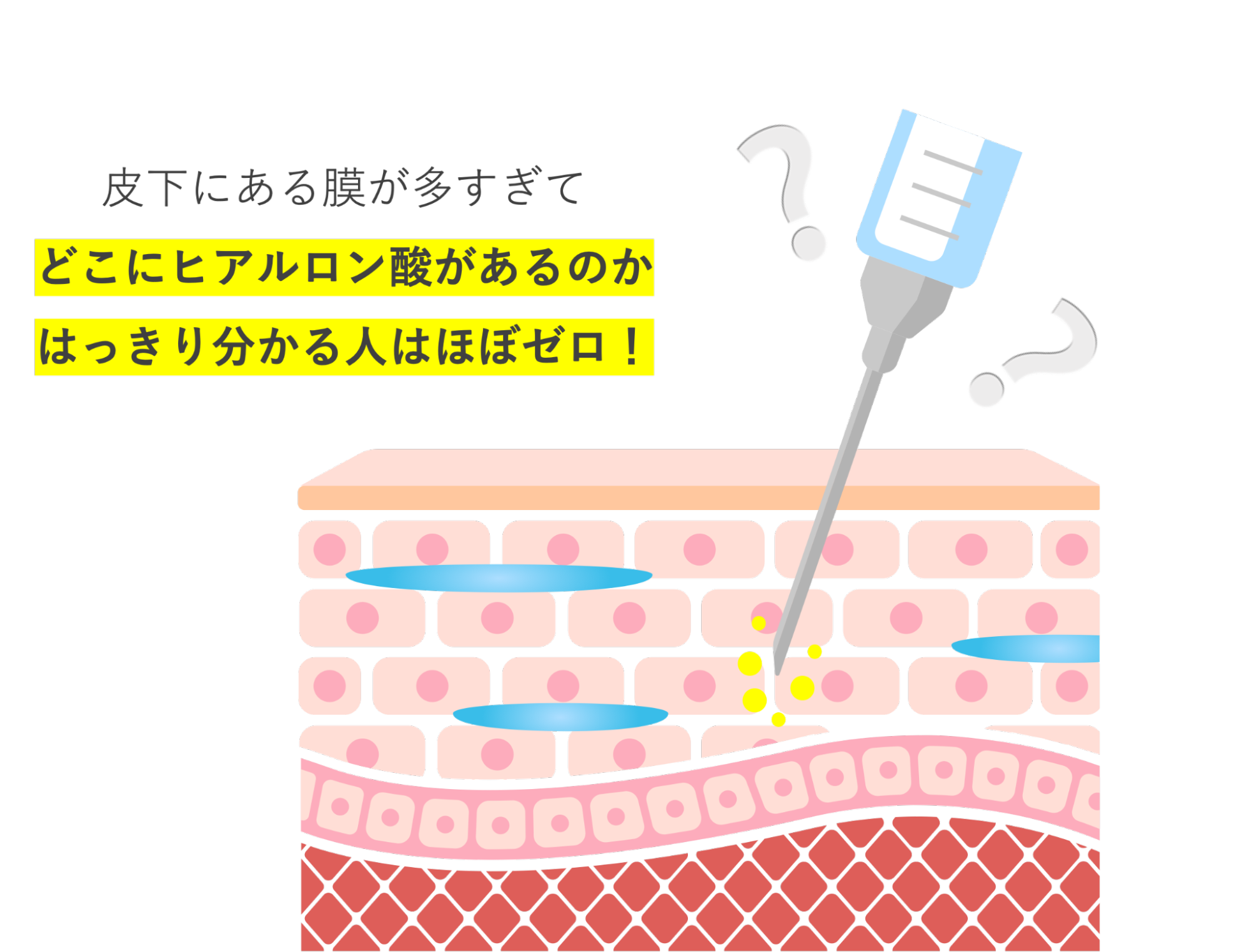 ヒアルロン酸がどこにあるか分からずに注射をするイメージ