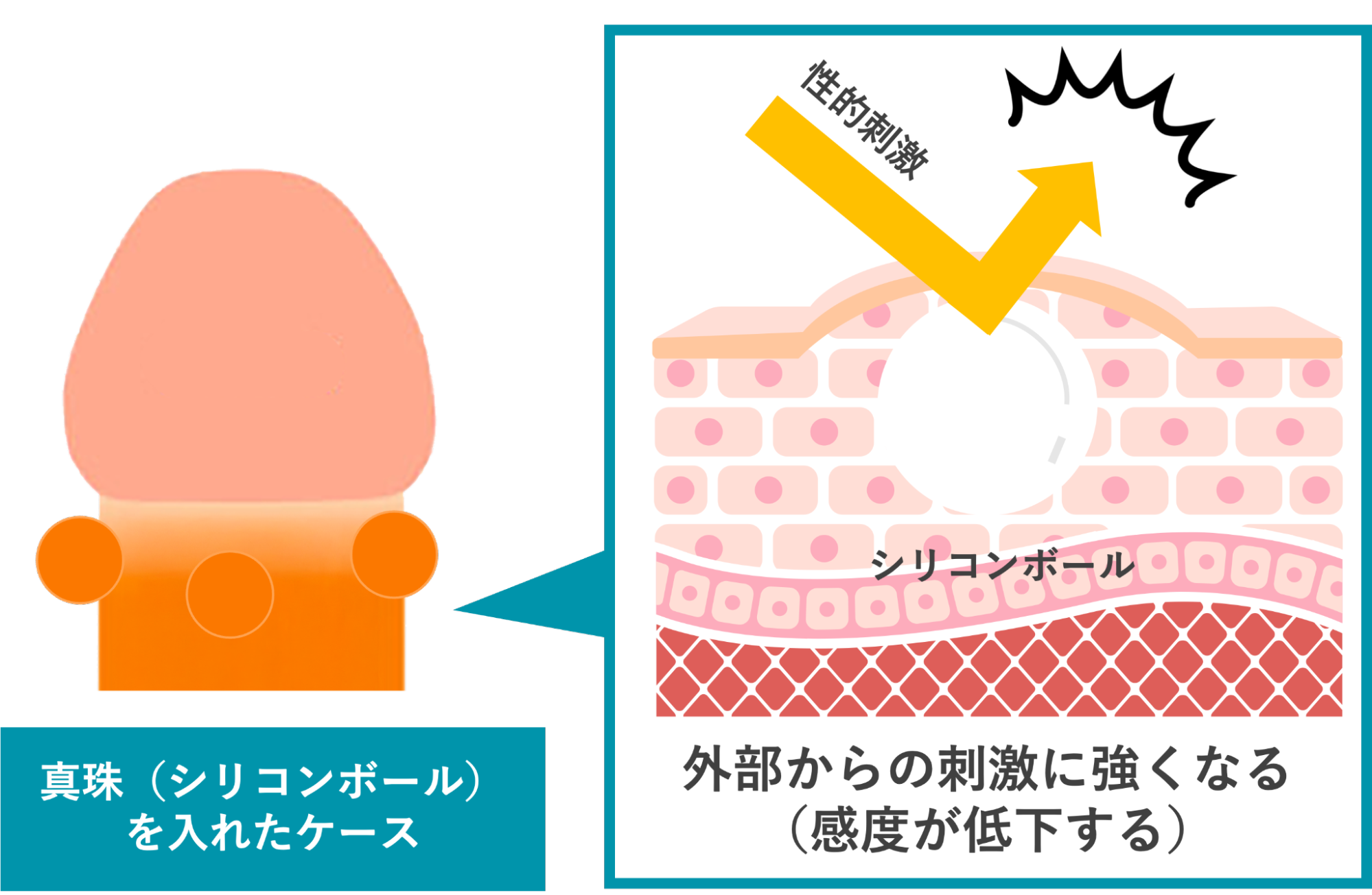 真珠によってガードされ感度が低下するイメージ