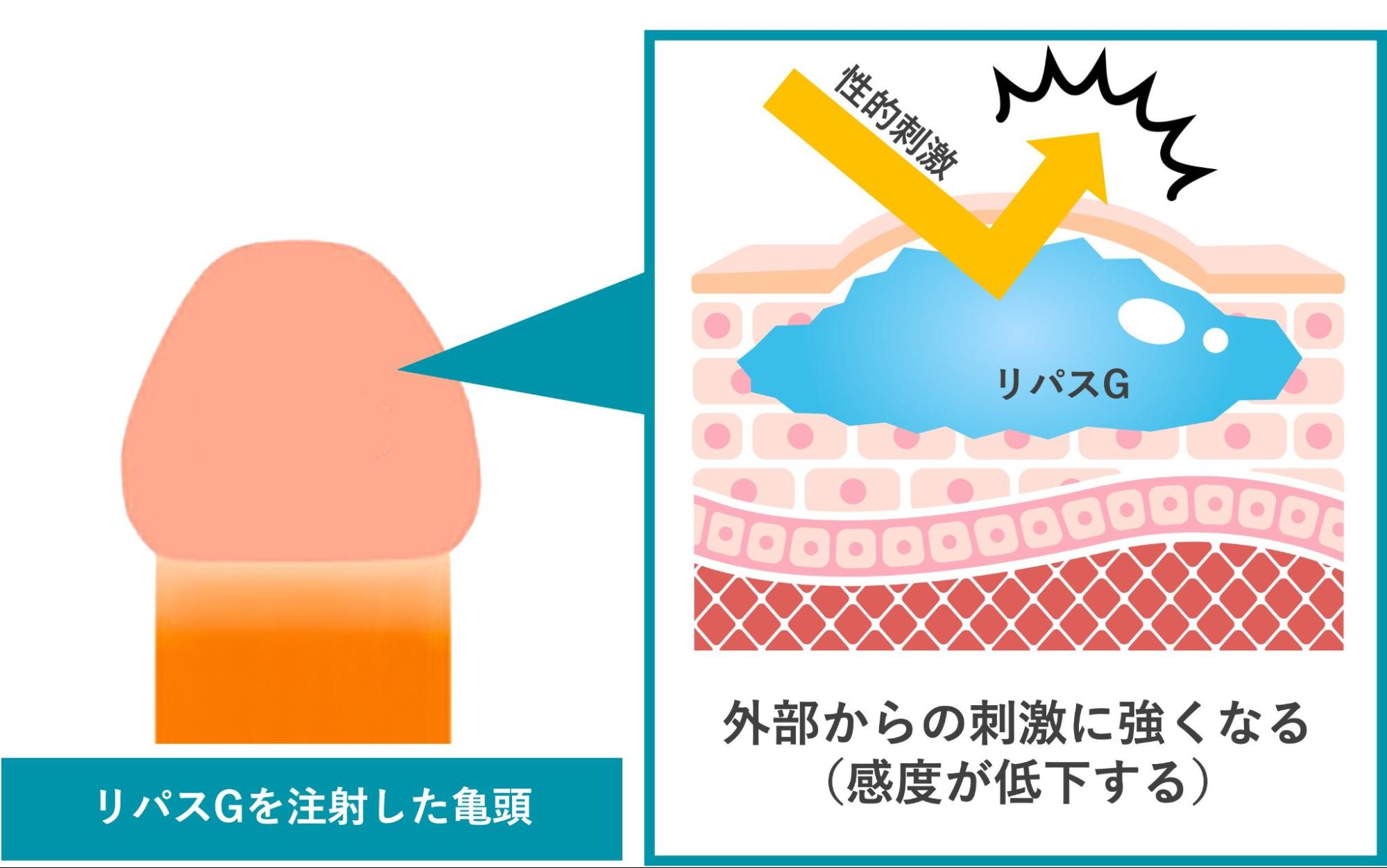 ペニスにリパスGを注入したことで性的刺激に強くなるイメージ