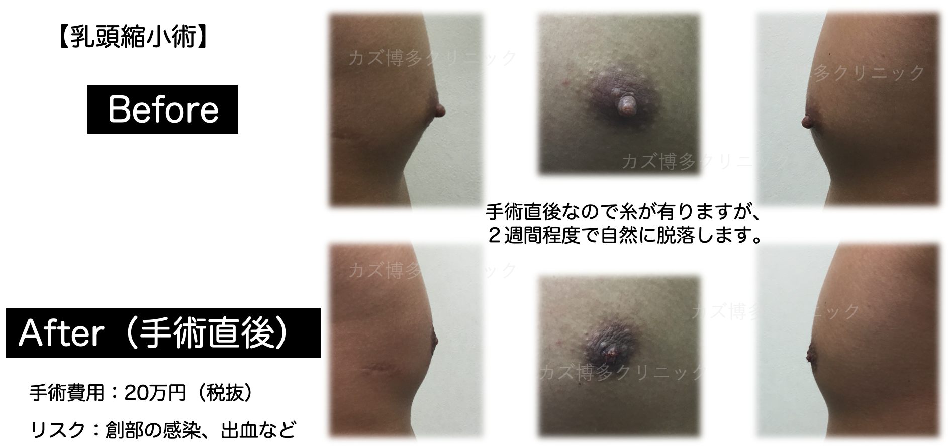 施術写真