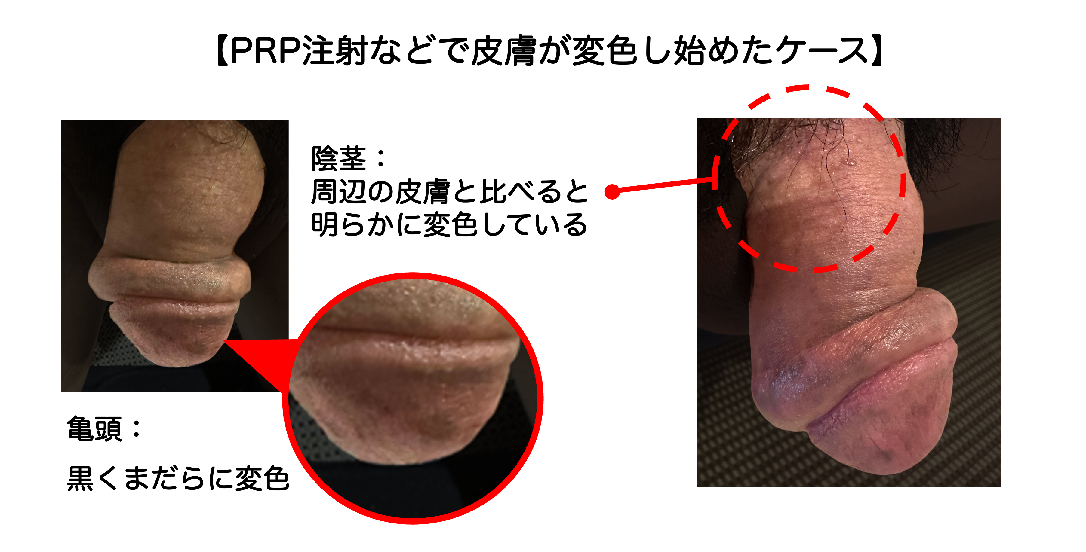 PRP注射などが原因で陰茎・亀頭が壊死した症例