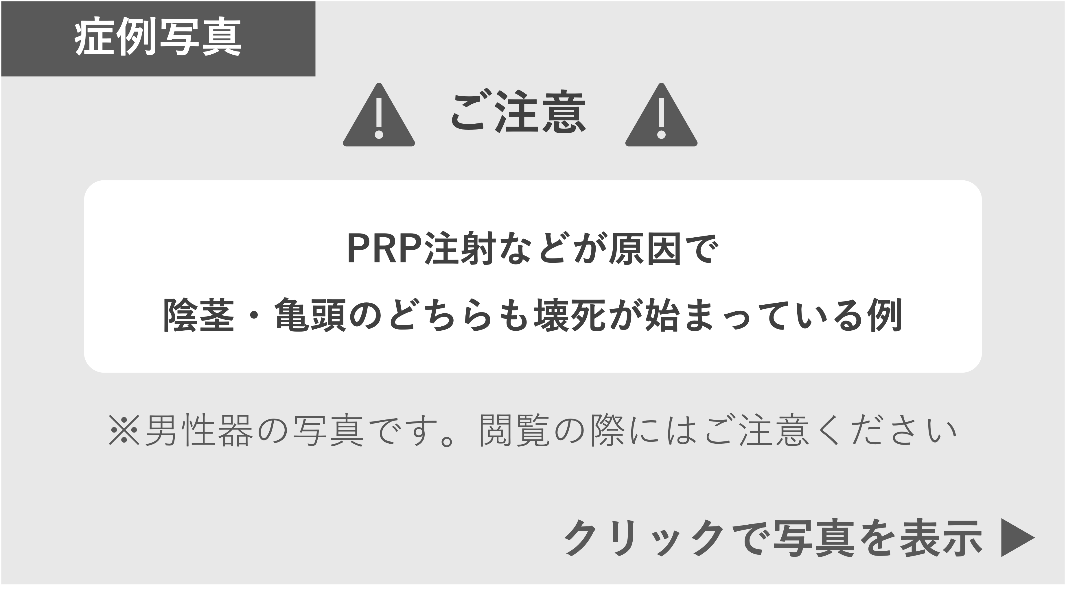 PRP注射などが原因で陰茎・亀頭が壊死した症例 症例写真閲覧の警告