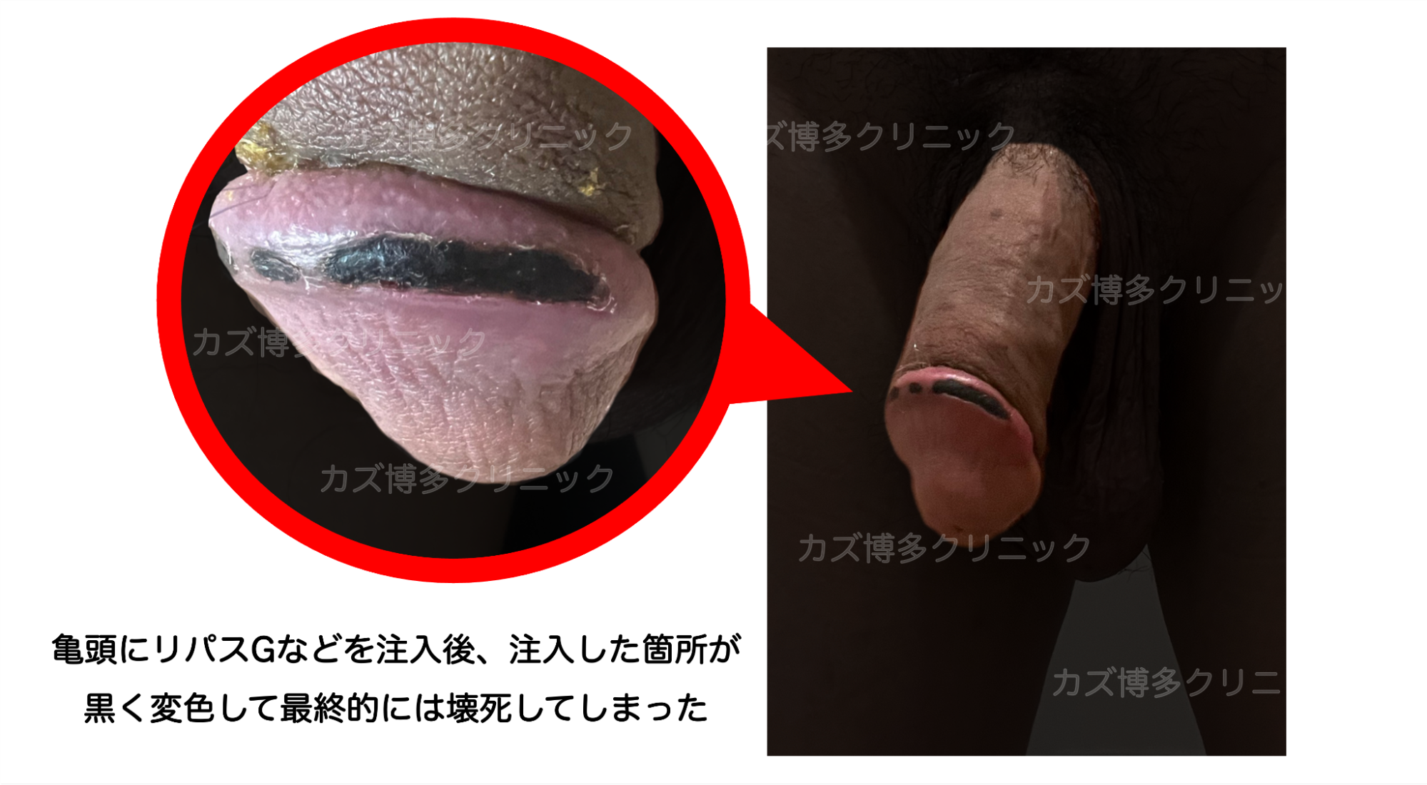 リパスGなどを注入したことで亀頭が壊死した症例