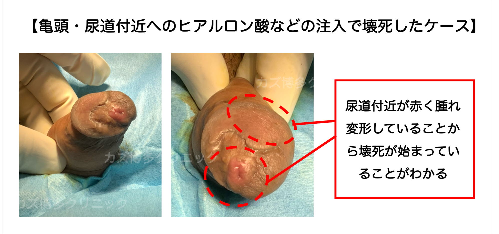 ヒアルロン酸などの注入で亀頭が壊死した症例