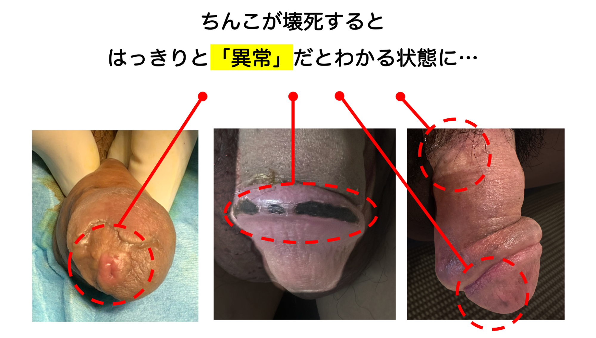 実際にちんこが壊死してしまった事例