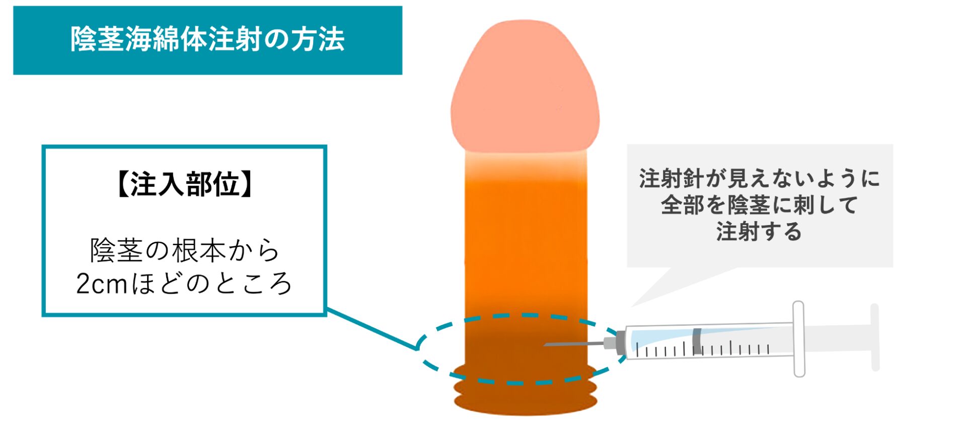 陰茎海綿体注射の方法を説明した図
