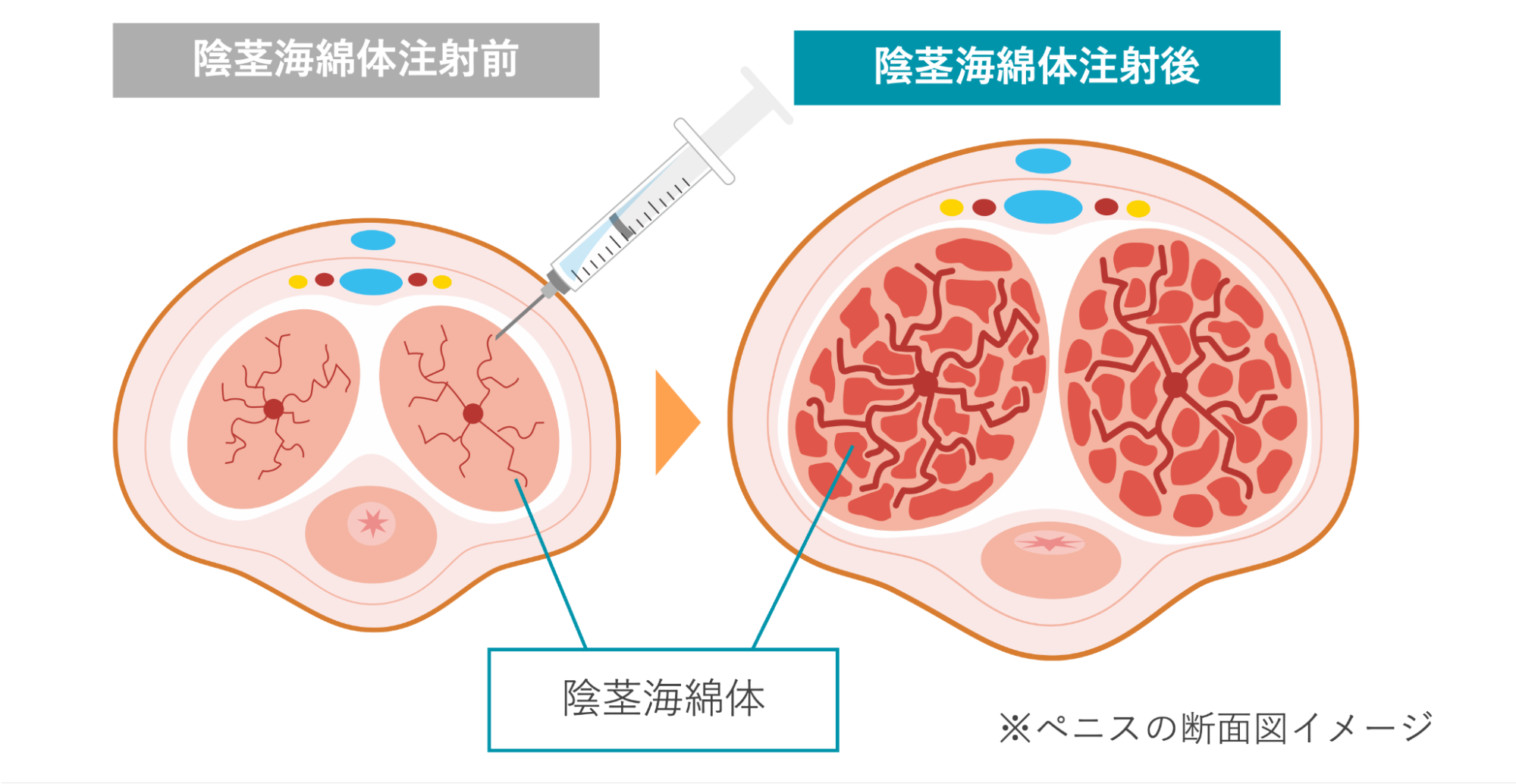 陰茎海綿体注射を行う前後の海綿体の状態のイメージ