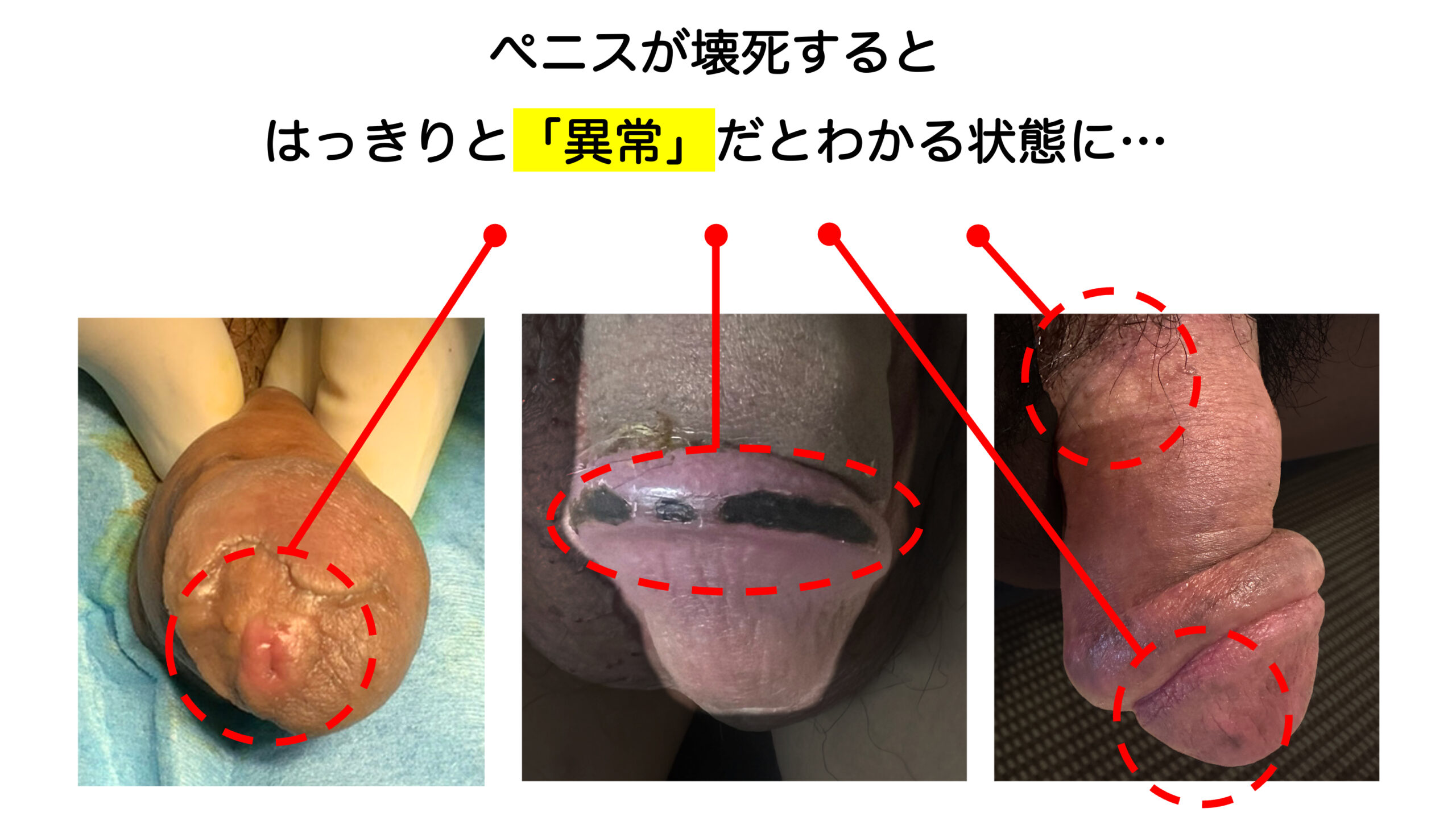 実際にペニスが壊死してしまった事例