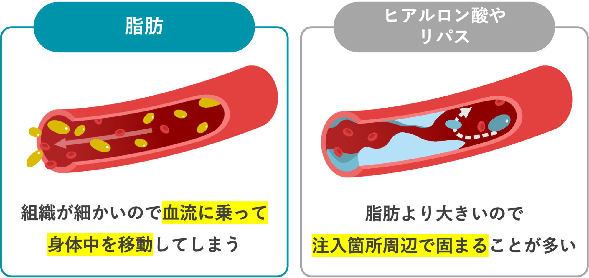脂肪注射とヒアルロン酸の血管に混入した際の違い
