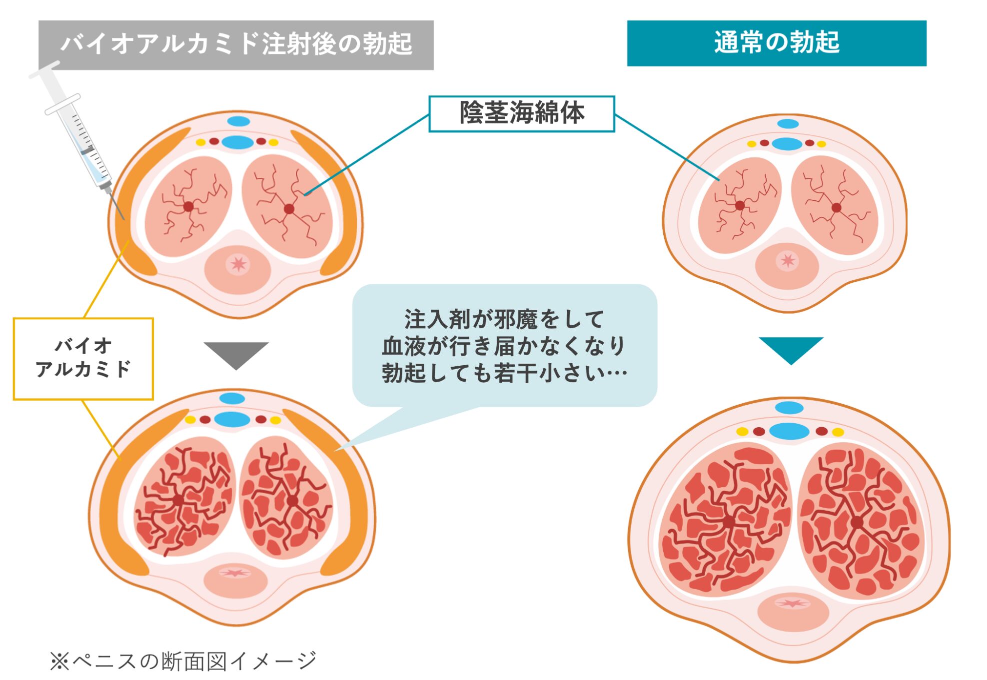 バイオアルカミド注射後の勃起と通常の勃起のイメージ