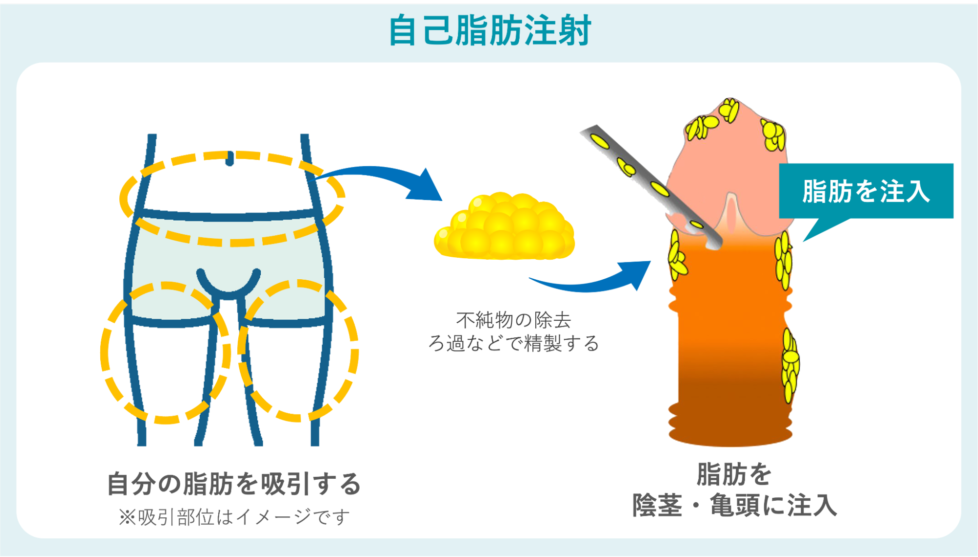 ペニスに自己脂肪注射を行う場合の概要