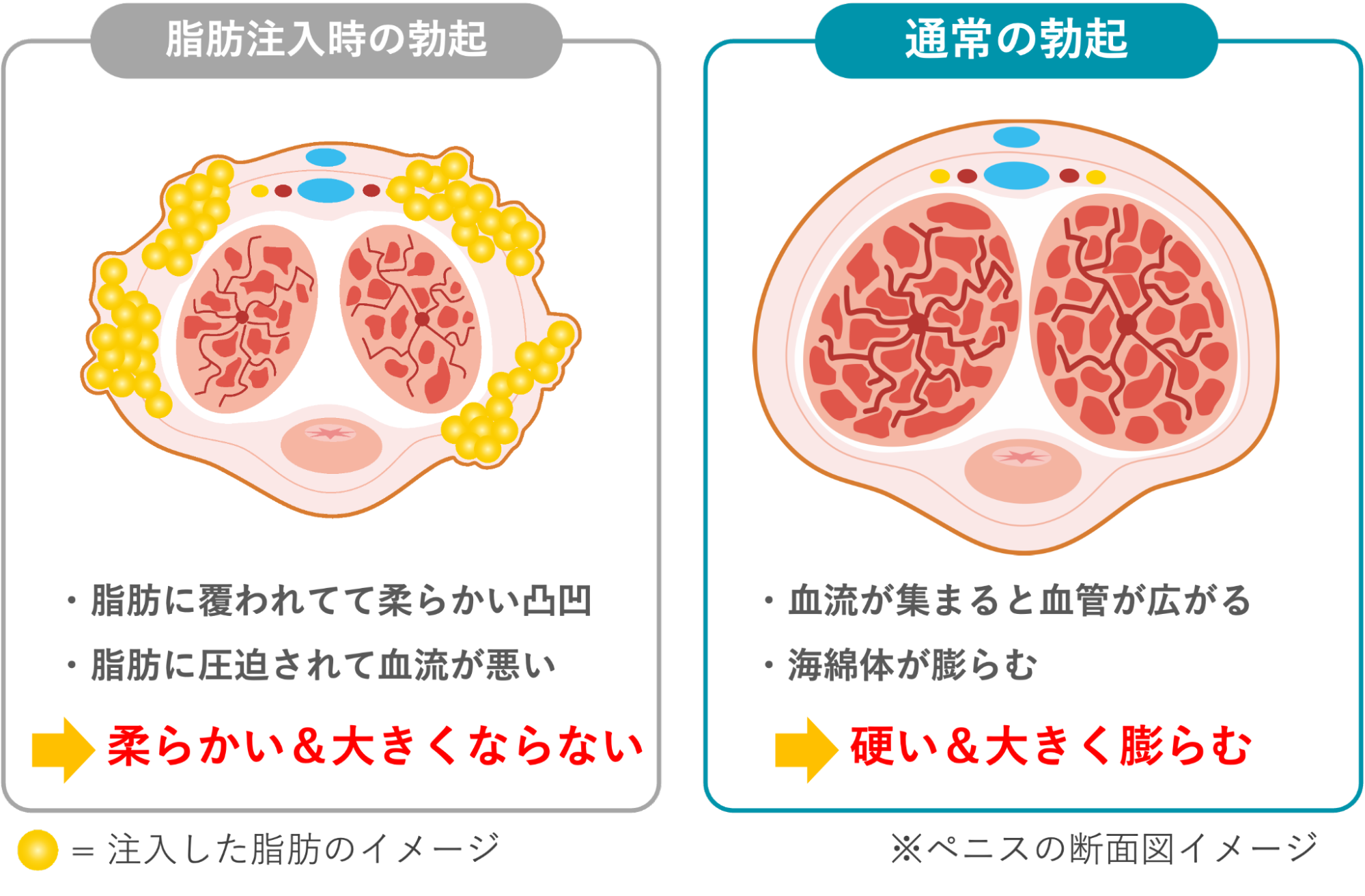 脂肪注入時の勃起と通常の勃起の違い