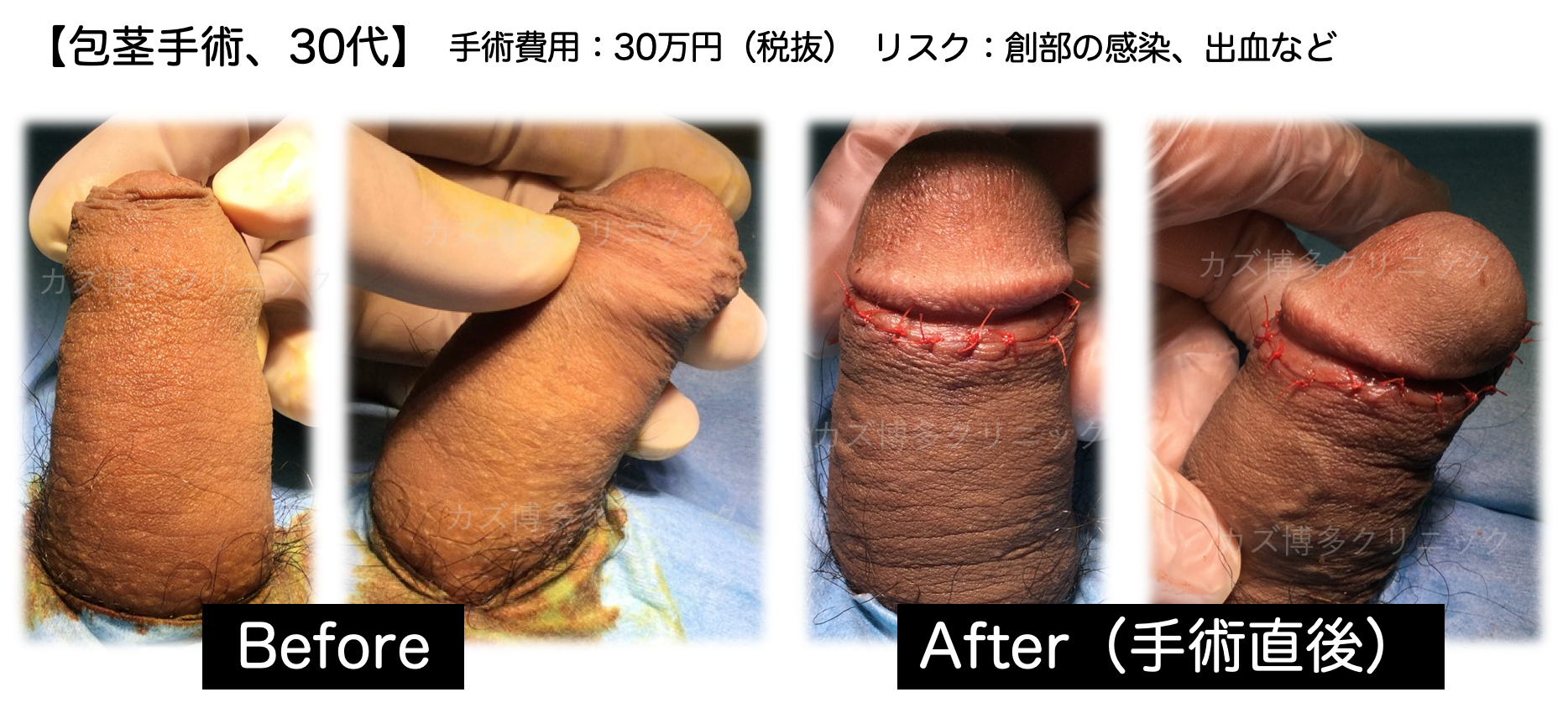 包茎手術で理想通りの見た目になった症例