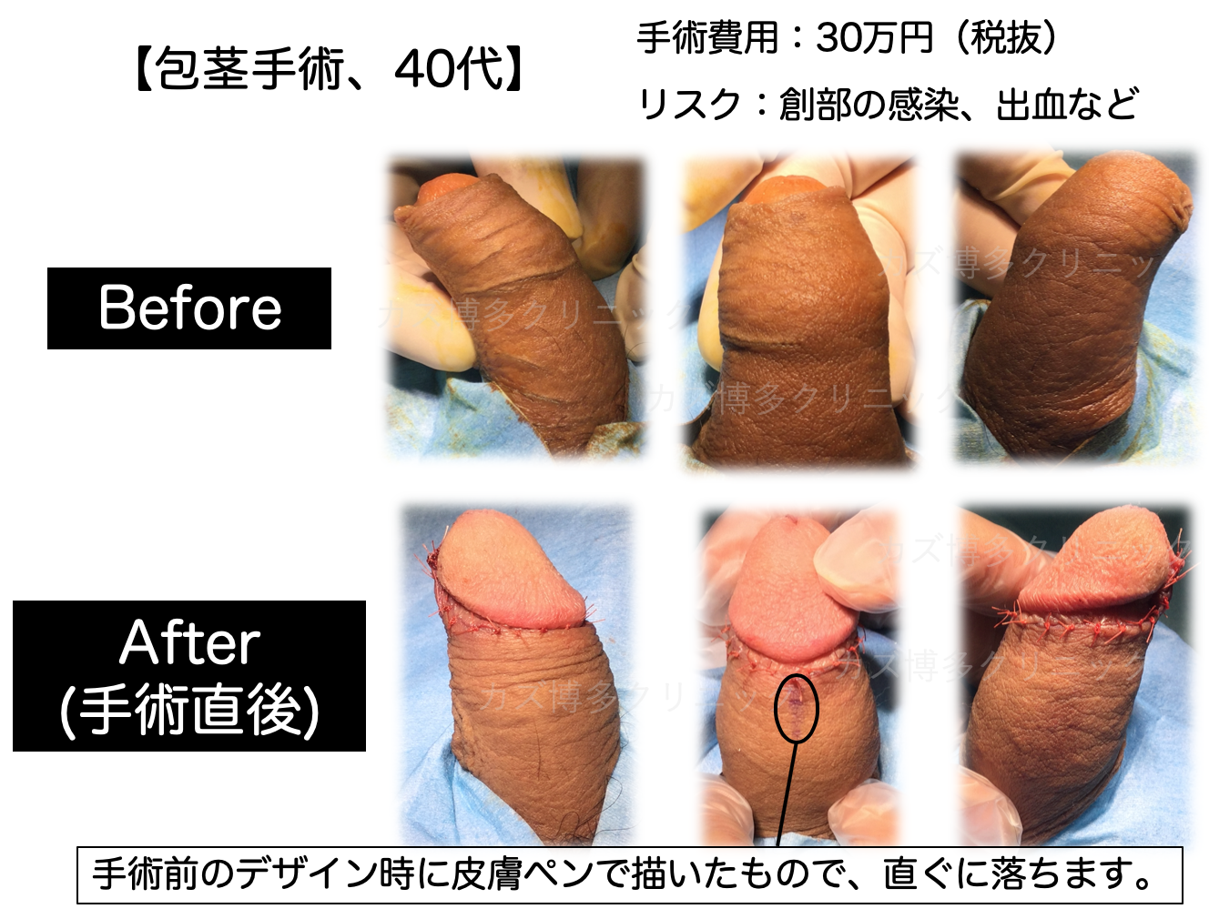 包茎手術で理想通りの見た目になった症例