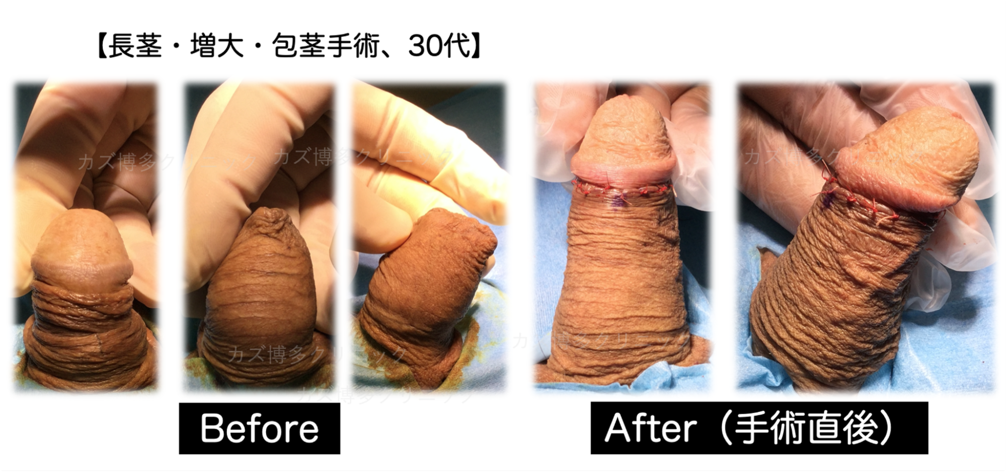 包茎手術とリミッター解除法の同時手術をした症例