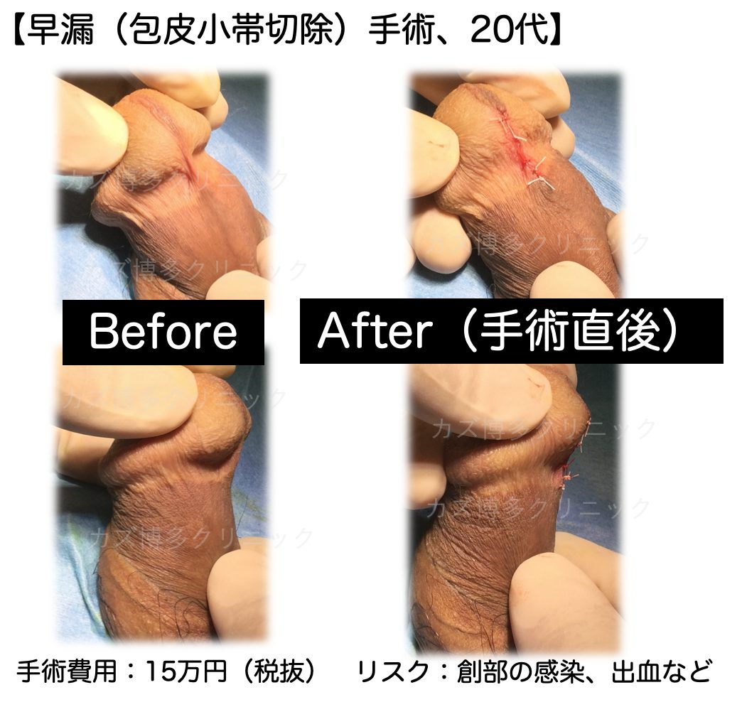 包皮小帯切除術で早漏が改善した症例