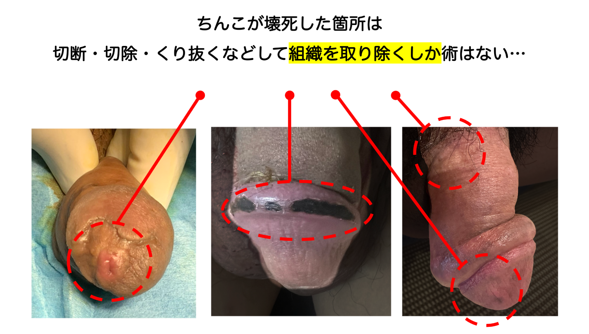 実際にちんこが壊死してしまった事例